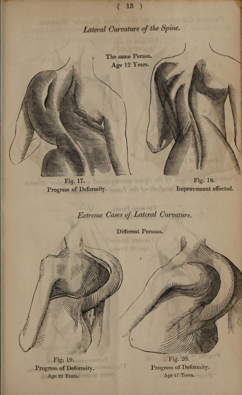 Lateral Curvature of the Spine. Fig. 17. Fig. 18. Progress of Deformity. Improvement effected. Extreme Cases of Lateral Curvature. Different Persons. Progress of Deformity. Progress of Defoi mitv Age 22 Years, Age 17 Years.