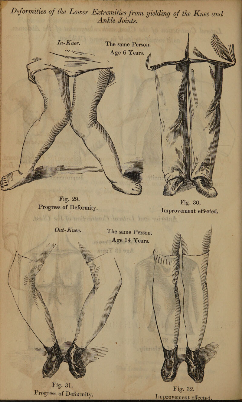 Deformities of the Lower Extremities from yielding of the Knee and Ankle Joints. Fig. 29. Progress of Deformity. Fig. 30. Improvement effected. Out-Knee. Fiie same Person. Age 14 Years. Fig-. 3], Progress of Deformity, Fisr. 32. Dnprovemen^ffected.