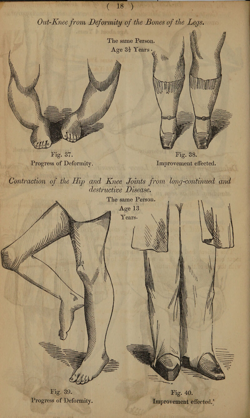 Out-Knee from Deformity of the Bones of the Legs. The same Person. Age 3t Years • Fig. 37. Progress of Deformity. Fig. 38. Improvement effected. Contraction of the Hip and Knee Joints from long-continued and destructive Disease. The same Person. Age 13 Years. Fig. 39. Fig. 40.