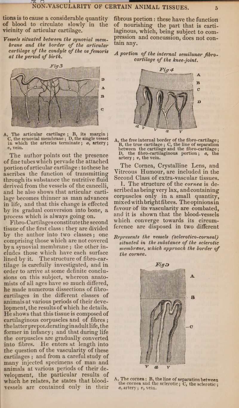 NON-VASCULARITY OF CERTAIN ANIMAL TISSUES. lions is to cause a considerable quantity of blood to circulate slowly in the vicinity of articular cartilage. Vessels situated between the synovial mem¬ brane and the border of the articular cartilage of the condyle of the osfemoris at the period of birth. A, The articular cartilage ; B, its margin; C, the synovial membrane ; D, the single vessel in which the arteries terminate; a, artery; v, vein. The author points out the presence of fine tubes which pervade the attached portion of articular cartilage : to these he ascribes the function of transmitting through its substance the nutritive fluid derived from the vessels of the cancelli, and he also shows that articular carti¬ lage becomes thinner as man advances in life, and that this change is effected by its gradual conversion into bone, a process which is always going on. Fibro-Cartilages constitute the second tissue of the first class : they are divided by the author into two classes; one comprising those which are not covered by a synovial membrane ; the other in¬ cludes those which have each surface lined by it. The structure of fibro-car- tilage is carefully investigated, and in order to arrive at some definite conclu¬ sions on this subject, whereon anato¬ mists of all ages have so much differed, he made numerous dissections of fibro- cartilages in the different classes of animals at various periods of their deve¬ lopment, the results of which he details. He shows that this tissue is composed of cartilaginous corpuscles and of fibres ; the latter preponderating in adult life, the former in infancy; and that during life the corpuscles are gradually converted into fibres. He enters at length into the question of the vascularity of these cartilages ; and from a careful study of many injected specimens of man and animals at various periods of their de¬ velopment, the particular results of which he relates, he states that blood¬ vessels are contained only in their fibrous portion: these have the function of nourishing the part that is carti¬ laginous, which, being subject to com¬ pression and concussion, does not con¬ tain any. A portion of the internal semilunar fibro- cartilage of the knee-joint. A, the free internal border of the fibro-cartilage; B, the true cartilage ; C, the line of separation between the cartilage and the fibro-cartilage; D, the fibro-cartilaginous portion; a, the artery ; v, the vein. The Cornea, Crystalline Lens, and Vitreous Humour, are included in the Second Class of extra-vascular tissues. 1. The structure of the cornea is de¬ scribed as being very lax, andcontaining corpuscles only in a small quantity, mixed with bright fibres. Theopinionsin favour of its vascularity are combated, and it is shown that the blood-vessels which converge towards its circum¬ ference are disposed in two different Represents the vessels fsclerotico-corneal) situated in the substance of the sclerotic membrane, which approach the border of the cornea. FiffD V a V A, The cornea; B, the line of separation between the cornea and the sclerotic; C, the sclerotic ; a, artery; v, vein.