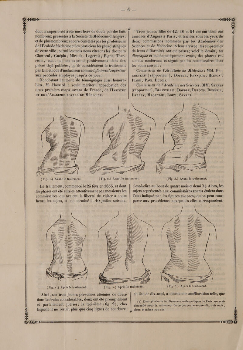dont la supériorité a été mise hors de doute par des faits nombreux présentés à la Société de Médecine d’Angers, et de plus nombreux encore constatés par les professeurs de 1 Ecole de Médecine et les praticiens les plus distingués de celle ville, parmi lesquels nous citerons les docteurs Chevreul, Guépin, Mirault, Logerais, Bigot, Thar- reau , etc., qui ont exprimé positivement dans des pièces déjà publiées, qu’ils considéraient le traitement par la méthode d’inclinaison comme infiniment supérieur aux procédés employés jusqu’à ce jour. Nonobstant l’autorité de témoignages aussi honora¬ bles, M. Hossard a voulu mériter l’approbation des deux premiers corps savans de France, de I'Institut et de l’Académie royale de Médecine. * Trois jeunes filles de 42, 16 et 21 ans ont donc été amenées d’Angers à Paris, et traitées sous les yeux de deux commissions nommées par les Académies des Sciences et de Médecine. A leur arrivée, les empreintes de leurs difformités ont été prises; voici le dessin, au diagraphe et mathématiquement exact, des plâtres re¬ connus conformes et signés par les commissaires dont les noms suivent : Commission de l'Académie de Médecine : MM. Bri- cheteau ( rapporteur ), Double , François , Husson , Itard, Paul Dubois. Commission de l’Académie des Sciences :MM. Serres (rapporteur), Blainville, Double, Dulong, Duméril, Larrey, Magendie, Roux, Savart. (Fig. 2.) Avant le traitement. (Fig. 3.) Avant le traitement. Le traitement, commencé le23 février 1855, et dont les phases ont été suivies attentivement par messieurs les commissaires qui avaient la liberté de visiter à toute heure les sujets, a été terminé le 10 juillet suivant, c’est-à-dire au bout de quatre mois et demi (1). Alors, les sujets représentés aux commissaires réunis étaient dans l’état indiqué par les figures ci-après, qu’on peut com¬ parer aux précédentes auxquelles elles correspondent. (Fig. i.) Après le traitement. (Fig. 2.) Après le traitement. (Fig. 3.) Après le traitement. Ainsi, sur trois jeunes personnes atteintes de dévia¬ tions latérales considérables, deux ont été promptement et parfaitement guéries; la troisième (fig. 2), chez laquelle il ne restait plus que cinq lignes de courbure, au lieu de dix-neuf, a obtenu une amélioration telle, que (i) Dans plusieurs étahlissemens orthopédiques de Paris on avait demandé pour le traitement de ces jeunes personnes dix-huit mois , deux et même trois ans.