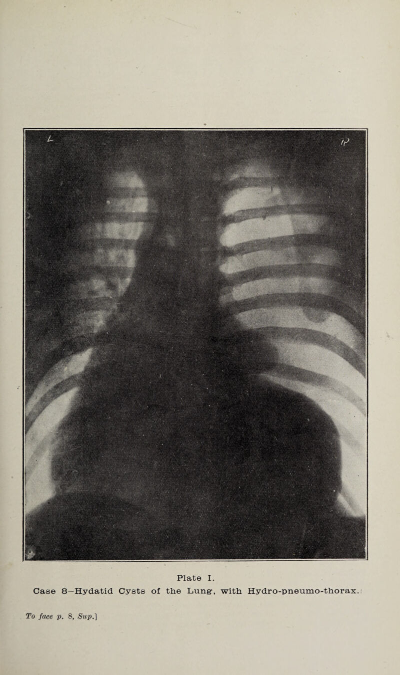Plate I. Case 8—Hydatid Cysts of the Lung-, with Hydro-pneumo-thorax. To face p. 8, Swp*]