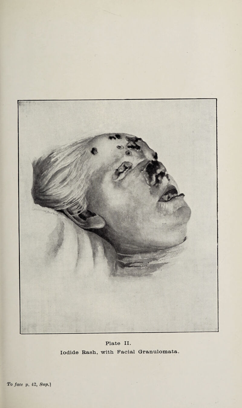 Plate II. Iodide Rash, with Facial Granulomata. To face p. 42, Sup.]