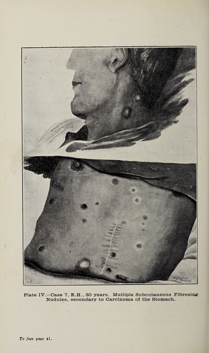 Nodules, secondary to Carcinoma of the Stomach. To face page 41