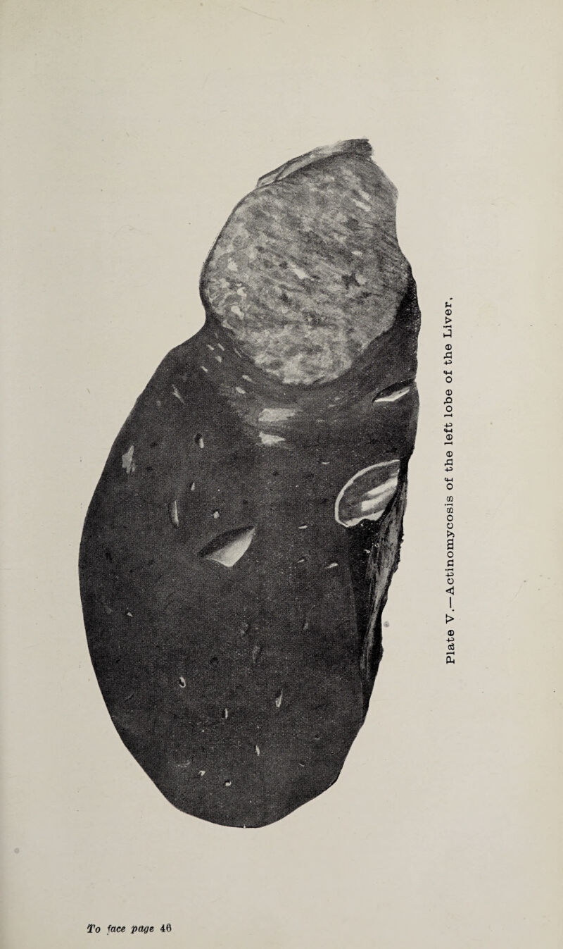 To face page 40 Plate V.—Actinomycosis of the left lobe of the Liver,