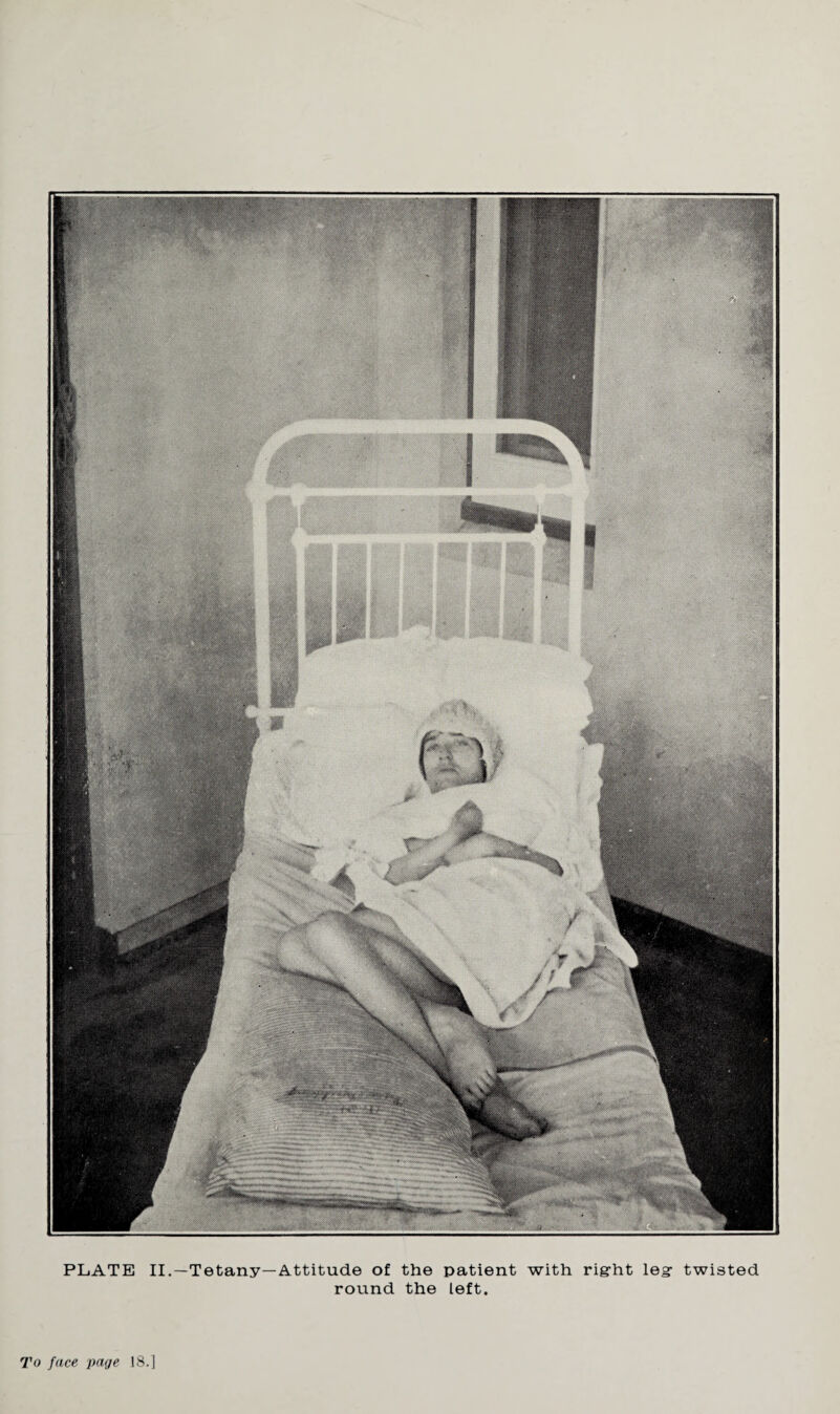PLATE II.—Tetany—Attitude of the patient with rig-ht leg- twisted round the left. To face page 18.]