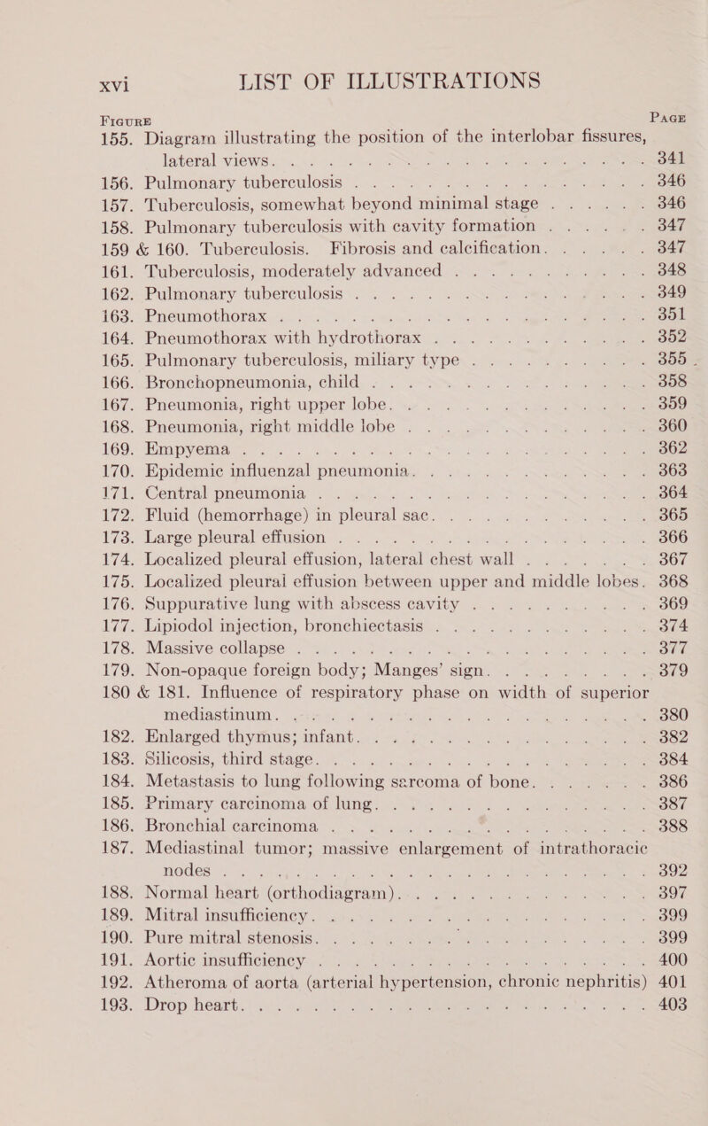 156. 157. Diagram illustrating the position of the interlobar fissures, lateral views. ae Pulmonary tuberculosis . a2 Tuberculosis, somewhat beyond iia imall Mone Pulmonary tuberculosis with cavity formation . Tuberculosis, moderately advanced . Pulmonary tuberculosis . Pneumothorax . ; Pneumothorax with bavdtuchanet: F Pulmonary tuberculosis, miliary type . Bronchopneumonia, child . Pneumonia, right upper lobe. Pneumonia, right middle lobe . Himpyema eo... Epidemic iauenvals pneumonia. Central pneumonia . Fluid (hemorrhage) in pleural» sac. Large pleural effusion . ; Localized pleural effusion, ekoual alieat alls : Localized pleural effusion between upper and middle lBbees Suppurative lung with abscess cavity . Lipiodol injection, bronchiectasis . Massive collapse . Non-opaque foreign hod Ninuaees’s sign. mediastinum . Enlarged thymus; eae Silicosis, third stage. Metastasis to lung ate sarcoma a bones Primary carcinoma of lung. Bronchial carcinoma . ' Mediastinal tumor; massive enlangement at snbraaboracls nodes . ee Normal heart (ovthadiagraen): Mitral insufficiency . Pure mitral stenosis. Aortic insufficiency . Atheroma of aorta taitcning he SeHencion, Sironic depnegs) Drop heart. 367 368 379 388 400 401