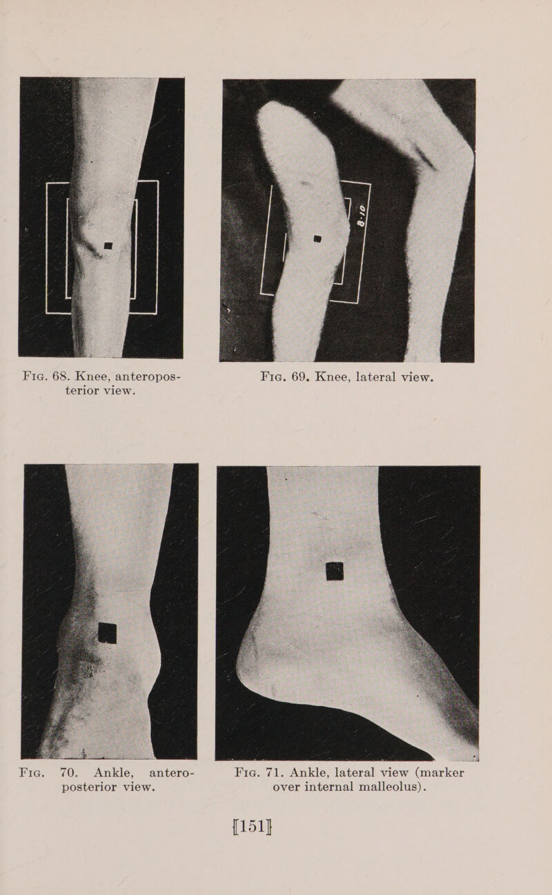  Fig. 68. Knee, anteropos- Fig. 69. Knee, lateral view. terior view.  ee as a Mil Fic. 70. Ankle, antero- Fig. 71. Ankle, lateral view (marker posterior view. over internal malleolus). [151]