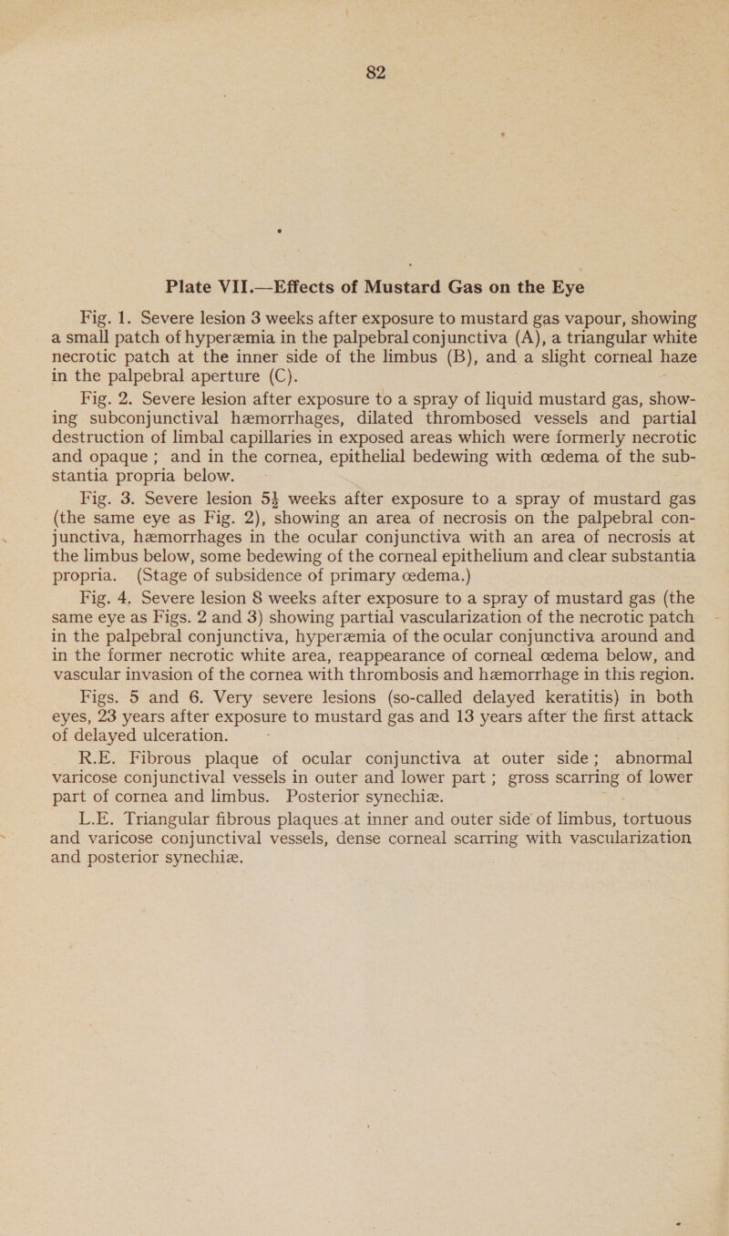 Plate VII.—Effects of Mustard Gas on the Eye Fig. 1. Severe lesion 3 weeks after exposure to mustard gas vapour, showing a small patch of hyperemia in the palpebral conjunctiva (A), a triangular white necrotic patch at the inner side of the limbus (B), and a slight corneal haze in the palpebral aperture (C). | : Fig. 2. Severe lesion after exposure to a spray of liquid mustard gas, show- ing subconjunctival hemorrhages, dilated thrombosed vessels and partial destruction of limbal capillaries in exposed areas which were formerly necrotic and opaque ; and in the cornea, epithelial bedewing with cedema of the sub- stantia propria below. Fig. 3. Severe lesion 54 weeks after exposure to a spray of mustard gas (the same eye as Fig. 2), showing an area of necrosis on the palpebral con- junctiva, hemorrhages in the ocular conjunctiva with an area of necrosis at the limbus below, some bedewing of the corneal epithelium and clear substantia propria. (Stage of subsidence of primary cedema.) Fig. 4, Severe lesion 8 weeks after exposure to a spray of mustard gas (the same eye as Figs. 2 and 3) showing partial vascularization of the necrotic patch in the palpebral conjunctiva, hyperzemia of the ocular conjunctiva around and in the former necrotic white area, reappearance of corneal cedema below, and vascular invasion of the cornea with thrombosis and hemorrhage in this region. Figs. 5 and 6. Very severe lesions (so-called delayed keratitis) in both eyes, 23 years after exposure to mustard gas and 13 years after the first attack of delayed ulceration. R.E. Fibrous plaque of ocular conjunctiva at outer side; abnormal varicose conjunctival vessels in outer and lower part ; gross scarring of lower part of cornea and limbus. Posterior synechiz. ' L.E. Triangular fibrous plaques.at inner and outer side of limbus, tortuous and varicose conjunctival vessels, dense corneal scarring with vascularization and posterior synechie.