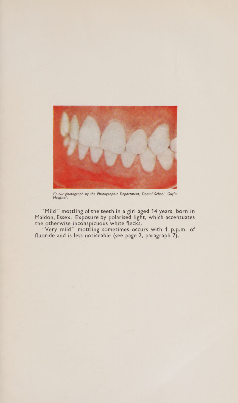  ‘“‘Mild’’ mottling of the teeth in a girl aged 14 years, born in Maldon, Essex. Exposure by polarised light, which accentuates the otherwise inconspicuous white flecks. ‘Very mild’’ mottling sometimes occurs with 1 p.p.m. of fluoride and is less noticeable (see page 2, paragraph 7).