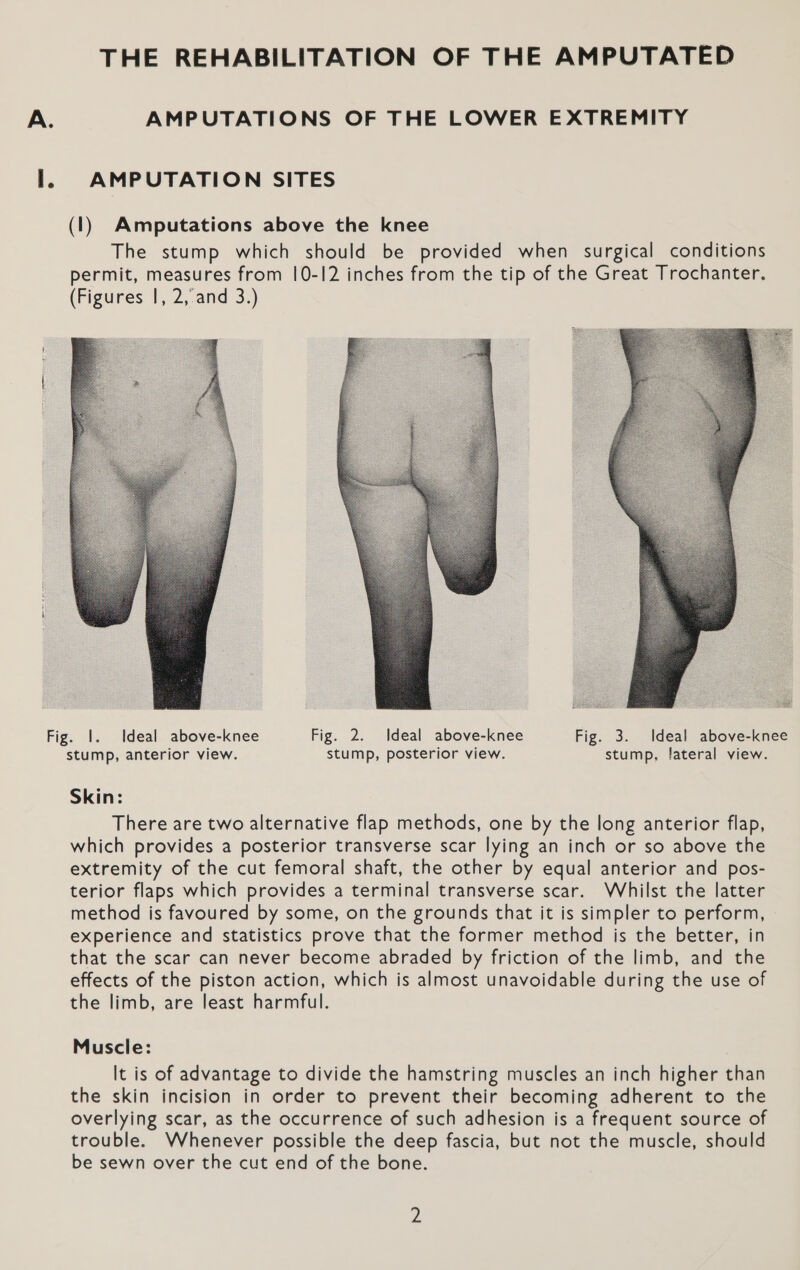 THE REHABILITATION OF THE AMPUTATED A. AMPUTATIONS OF THE LOWER EXTREMITY I. AMPUTATION SITES (1) Amputations above the knee The stump which should be provided when surgical conditions permit, measures from 10-12 inches from the tip of the Great Trochanter. (Figures |, 2,.and 3.)  Fig. 1. Ideal above-knee Fig. 2. Ideal above-knee Fig. 3. Ideal above-knee stump, anterior view. stump, posterior view. stump, lateral view. Skin: There are two alternative flap methods, one by the long anterior flap, which provides a posterior transverse scar lying an inch or so above the extremity of the cut femoral shaft, the other by equal anterior and pos- terior flaps which provides a terminal transverse scar. Whilst the latter method is favoured by some, on the grounds that it is simpler to perform, experience and statistics prove that the former method is the better, in that the scar can never become abraded by friction of the limb, and the effects of the piston action, which is almost unavoidable during the use of the limb, are least harmful. Muscle: It is of advantage to divide the hamstring muscles an inch higher than the skin incision in order to prevent their becoming adherent to the overlying scar, as the occurrence of such adhesion is a frequent source of trouble. Whenever possible the deep fascia, but not the muscle, should be sewn over the cut end of the bone.