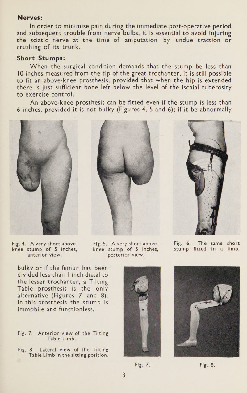 Nerves: In order to minimise pain during the immediate post-operative period and subsequent trouble from nerve bulbs, it is essential to avoid injuring the sciatic nerve at the time of amputation by undue traction or crushing of its trunk. Short Stumps: When the surgical condition demands that the stump be less than 10 inches measured from the tip of the great trochanter, it is still possible to fit an above-knee prosthesis, provided that when the hip is extended there is just sufficient bone left below the level of the ischial tuberosity to exercise control. An above-knee prosthesis can be fitted even if the stump is less than 6 inches, provided it is not bulky (Figures 4, 5 and 6); if it be abnormally  Fig. 4. Avery short above- Fig.5. Avery short above- Fig. 6. The same short knee stump of 5 inches, knee stump of 5 inches, stump fitted in a limb. anterior view. posterior view. bulky or if the femur has been divided less than | inch distal to the lesser trochanter, a Tilting Table prosthesis is the only alternative (Figures 7 and 8). In this prosthesis the stump is immobile and functionless. Fig. 7. Anterior view of the Tilting Table Limb. Fig. 8. Lateral view of the Tilting Table Limb in the sitting position. 