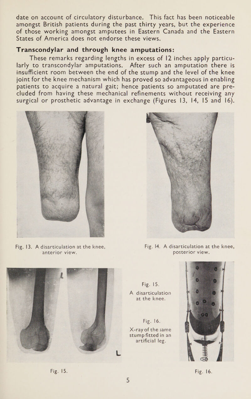 date on account of circulatory disturbance. This fact has been noticeable amongst British patients during the past thirty years, but the experience of those working amongst amputees in Eastern Canada and the Eastern States of America does not endorse these views. Transcondylar and through knee amputations: These remarks regarding lengths in excess of 12 inches apply particu- larly to transcondylar amputations. After such an amputation there is insufficient room between the end of the stump and the level of the knee joint for the knee mechanism which has proved so advantageous in enabling patients to acquire a natural gait; hence patients so amputated are pre- cluded from having these mechanical refinements without receiving any surgical or prosthetic advantage in exchange (Figures 13, 14, 15 and 16).  Fig. 13. A disarticulation at the knee, Fig. 14. A disarticulation at the knee, anterior view. posterior view. Fig. 15. A disarticulation at the knee. Fig. 16. X-ray of the same stump fitted in an artificial leg.   Fig. 15. Fig. 16.