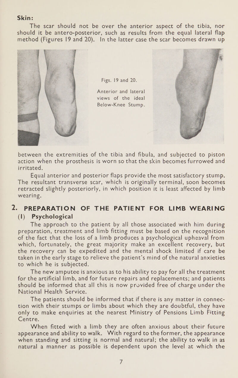 Skin: The scar should not be over the anterior aspect of the tibia, nor should it be antero-posterior, such as results from the equal lateral flap method (Figures 19 and 20). In the latter case the scar becomes drawn up Figs. lO and 20: Anterior and lateral views of the _ ideal Below-Knee Stump.  between the extremities of the tibia and fibula, and subjected to piston action when the prosthesis is worn so that the skin becomes furrowed and irritated. Equal anterior and posterior flaps provide the most satisfactory stump. The resultant transverse scar, which is originally terminal, soon becomes retracted slightly posteriorly, in which position it is least affected by limb wearing. 2. PREPARATION OF THE PATIENT FOR LIMB WEARING (1) Psychological The approach to the patient by all those associated with him during preparation, treatment and limb fitting must be based on the recognition of the fact that the loss of a limb produces a psychological upheaval from which, fortunately, the great majority make an excellent recovery, but the recovery can be expedited and the mental shock limited if care be taken in the early stage to relieve the patient’s mind of the natural anxieties to which he is subjected. The new amputee is anxious as to his ability to pay for all the treatment for the artificial limb, and for future repairs and replacements; and patients should be informed that all this is now provided free of charge under the National Health Service. The patients should be informed that if there is any matter in connec- tion with their stumps or limbs about which they are doubtful, they have only to make enquiries at the nearest Ministry of Pensions Limb Fitting Centre. When fitted with a limb they are often anxious about their future appearance and ability to walk. With regard to the former, the appearance when standing and sitting is normal and natural; the ability to walk in as natural a manner as possible is dependent upon the level at which the i