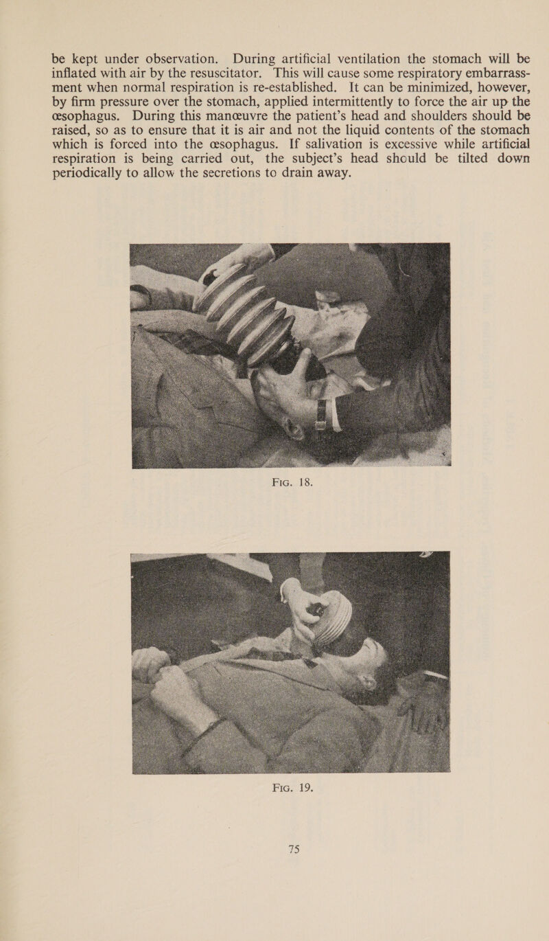 be kept under observation. During artificial ventilation the stomach will be inflated with air by the resuscitator. This will cause some respiratory embarrass- ment when normal respiration is re-established. It can be minimized, however, by firm pressure over the stomach, applied intermittently to force the air up the csophagus. During this manceuvre the patient’s head and shoulders should be raised, so as to ensure that it is air and not the liquid contents of the stomach which is forced into the cesophagus. If salivation is excessive while artificial respiration is being carried out, the subject’s head should be tilted down periodically to allow the secretions to drain away. 