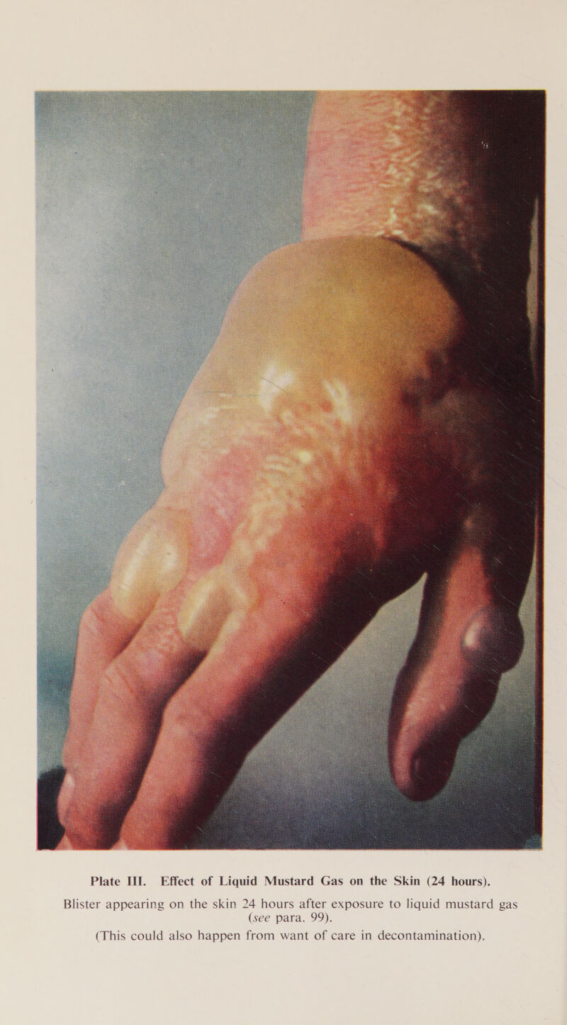  Blister appearing on the skin 24 hours after exposure to liquid mustard gas (see para. 99). (This could also happen from want of care in decontamination).