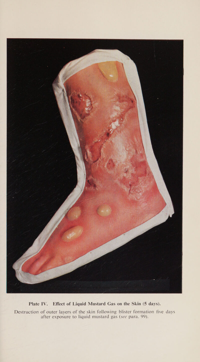  Destruction of outer layers of the skin following blister formation five days after exposure to liquid mustard gas (see para. 99).