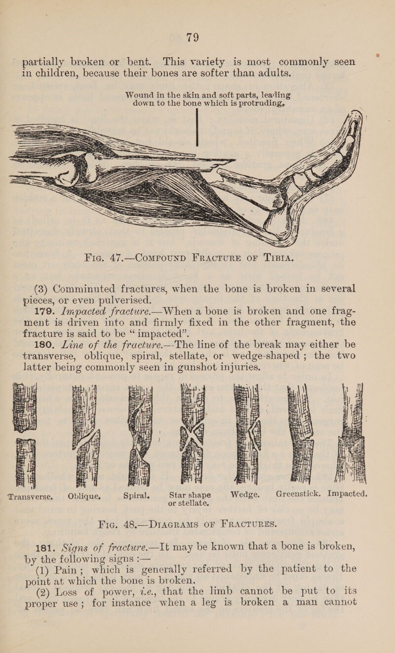 ies, partially broken or bent. This variety is most commonly seen in children, because their bones are softer than adults.   Fic. 47.—CompounpD FRACTURE OF TIBIA. (3) Comminuted fractures, when the bone is broken in several pieces, or even pulverised. 179. Impacted fracture—When a bone is broken and one frag- ment is driven into and firmly fixed in the other fragment, the fracture is said to be “ impacted”. 180. Line of the fracture.—-The line of the break may either be transverse, oblique, spiral, stellate, or wedge-shaped ; the two latter being commonly seen in gunshot injuries,      e= 2  us Transverse. Oblique,  Star shape Wedge. Greenstick. Impacted. or stellate. Fic. 48.— DIAGRAMS OF FRACTURES. 181. Signs of fracture.—It may be known that a bone is broken, by the following signs :— (1) Pain; which is generally referred by the patient to the point at which the bone is broken. (2) Loss of power, ze. that the limb cannot be put to its proper use; for instance when a leg is broken a man cannot