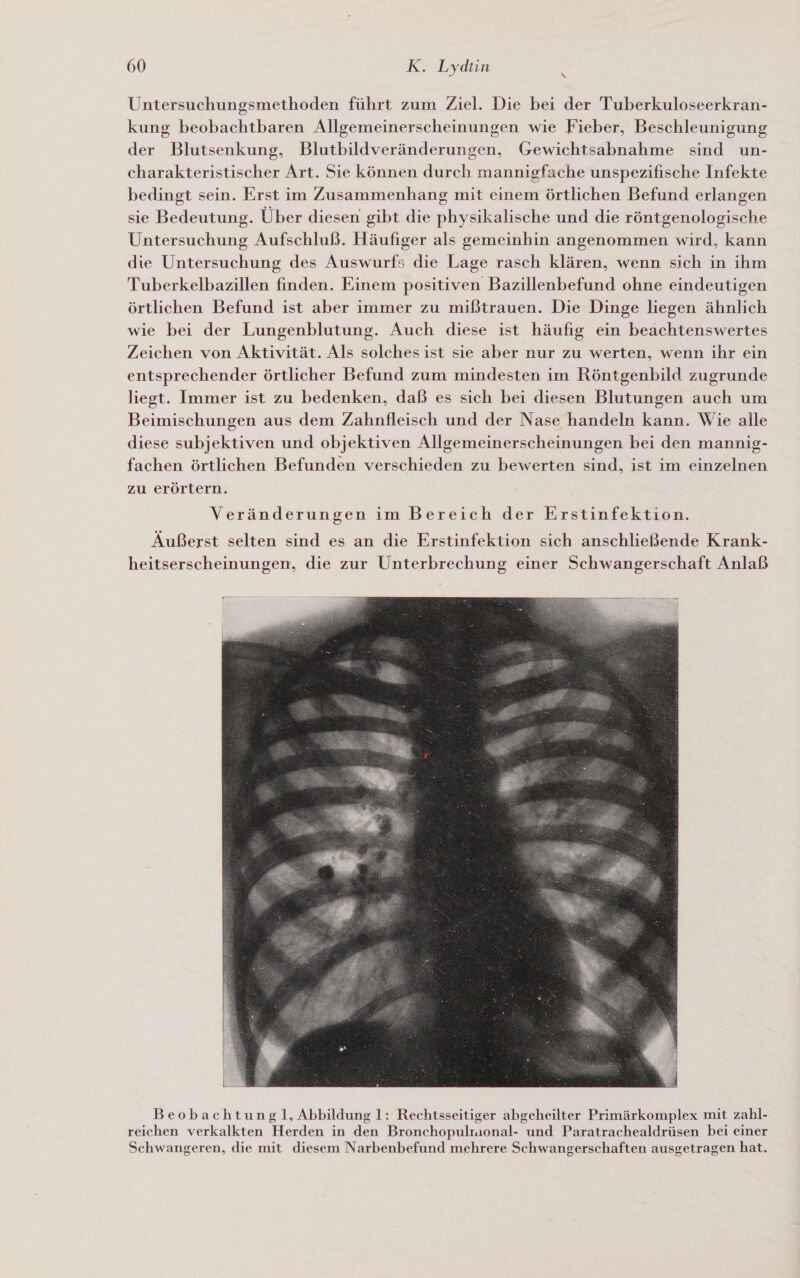 &gt; Untersuchungsmethoden führt zum Ziel. Die bei der Tuberkuloseerkran- kung beobachtbaren Allgemeinerscheinungen wie Fieber, Beschleunigung der Blutsenkung, Blutbildveränderungen, Gewichtsabnahme sind un- charakteristischer Art. Sie können durch mannigfache unspezifische Infekte bedingt sein. Erst im Zusammenhang mit einem örtlichen Befund erlangen sie Bedeutung. Über diesen gibt die physikalische und die röntgenologische Untersuchung Aufschluß. Häufiger als gemeinhin angenommen wird, kann die Untersuchung des Auswurfs die Lage rasch klären, wenn sich in ihm Tuberkelbazillen finden. Einem positiven Bazillenbefund ohne eindeutigen örtlichen Befund ist aber immer zu mißtrauen. Die Dinge liegen ähnlich wie bei der Lungenblutung. Auch diese ist häufig ein beachtenswertes Zeichen von Aktivität. Als solches ist sie aber nur zu werten, wenn ihr ein entsprechender örtlicher Befund zum mindesten im Röntgenbild zugrunde liegt. Immer ist zu bedenken, dab es sich bei diesen Blutungen auch um Beimischungen aus dem Zahnfleisch und der Nase handeln kann. Wie alle diese subjektiven und objektiven Allgemeinerscheinungen bei den mannig- fachen örtlichen Befunden verschieden zu bewerten sind, ist im einzelnen zu erörtern. Veränderungen im Bereich’der Erstinfektion. Äußerst selten sind es an die Erstinfektion sich anschließende Krank- heitserscheinungen, die zur Unterbrechung einer Schwangerschaft Anlaß  Beobachtungl, Abbildung 1: Rechtsseitiger abgeheilter Primärkomplex mit zahl- reichen verkalkten Herden in den Bronchopulmonal- und Paratrachealdrüsen bei einer Schwangeren, die mit diesem Narbenbefund mehrere Schwangerschaften ausgetragen hat.