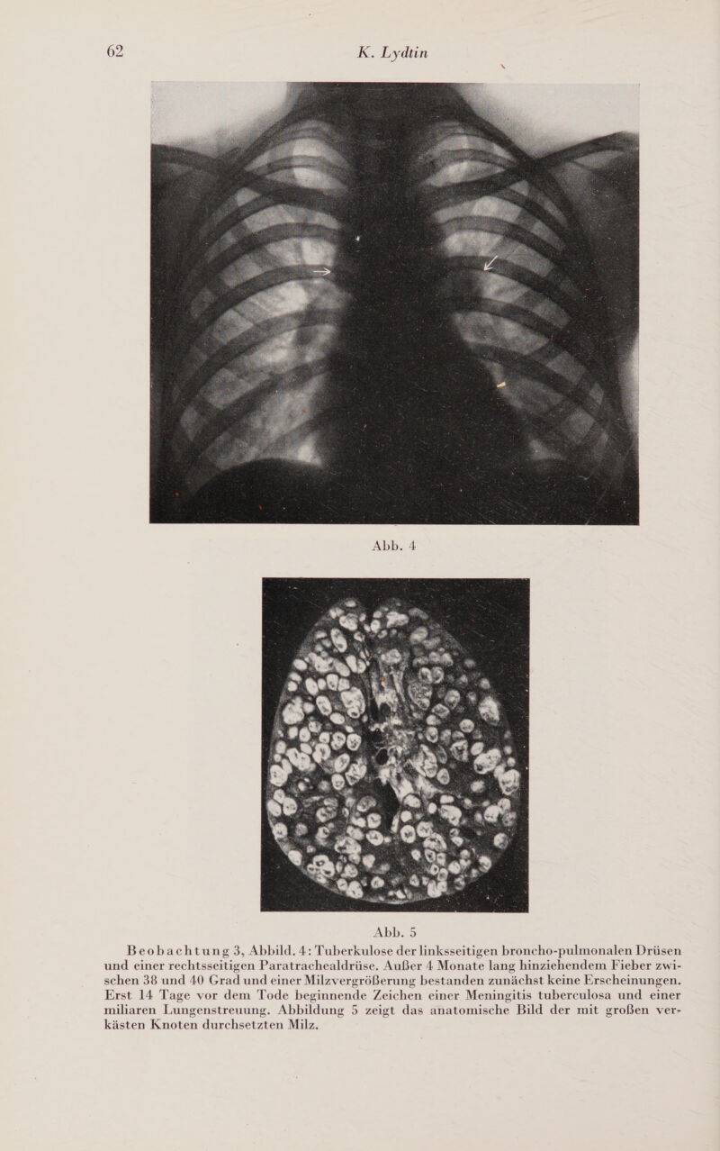  Abb. 4  Beobachtung 3, Abbild. 4: Tuberkulose der linksseitigen broncho-pulmonalen Drüsen und einer rechtsseitigen Paratrachealdrüse. Außer 4 Monate lang hinziehendem Fieber zwi- schen 38 und 40 Grad und einer Milzvergrößerung bestanden zunächst keine Erscheinungen. Erst 14 Tage vor dem Tode beginnende Zeichen einer Meningitis tuberculosa und einer miliaren Lungenstreuung. Abbildung 5 zeigt das anatomische Bild der mit großen ver- kästen Knoten durchsetzten Milz.