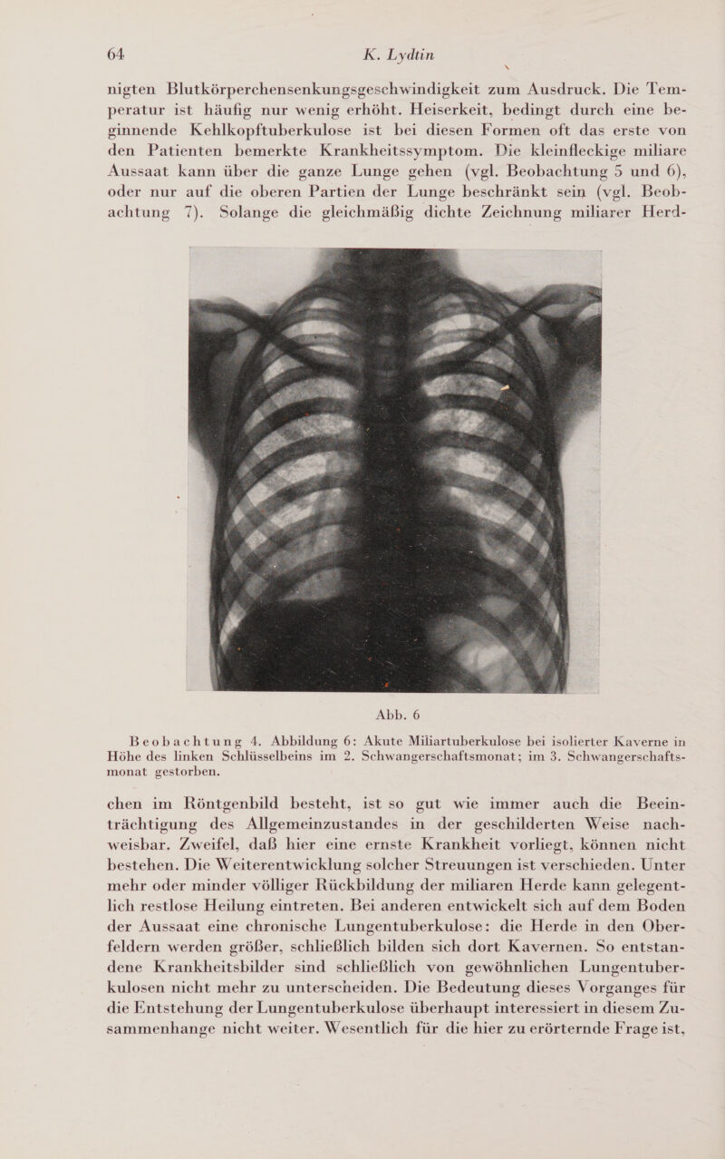 N nigten Blutkörperchensenkungsgeschwindigkeit zum Ausdruck. Die 'Tem- peratur ist häufig nur wenig erhöht. Heiserkeit, bedingt durch eine be- ginnende Kehlkopftuberkulose ist bei diesen Formen oft das erste von den Patienten bemerkte Krankheitssymptom. Die kleinfleckige miliare Aussaat kann über die ganze Lunge gehen (vgl. Beobachtung 5 und 6), oder nur auf die oberen Partien der Lunge beschränkt sein (vgl. Beob- achtung 7). Solange die gleichmäßig dichte Zeichnung miliarer Herd-  Beobachtung 4. Abbildung 6: Akute Miliartuberkulose bei isolierter Kaverne in Höhe des linken Schlüsselbeins im 2. Schwangerschaftsmonat; im 3. Schwangerschafts- monat gestorben. chen im Röntgenbild besteht, ist so gut wie immer auch die Beein- trächtigung des Allgemeinzustandes in der geschilderten Weise nach- weisbar. Zweifel, daß hier eine ernste Krankheit vorliegt, können nicht bestehen. Die Weiterentwicklung solcher Streuungen ist verschieden. Unter mehr oder minder völliger Rückbildung der miliaren Herde kann gelegent- lich restlose Heilung eintreten. Bei anderen entwickelt sich auf dem Boden der Aussaat eine chronische Lungentuberkulose: die Herde in den Ober- feldern werden größer, schließlich bilden sich dort Kavernen. So entstan- dene Krankheitsbilder sind schließlich von gewöhnlichen Lungentuber- kulosen nicht mehr zu unterscheiden. Die Bedeutung dieses Vorganges für die Entstehung der Lungentuberkulose überhaupt interessiert in diesem Zu- sammenhange nicht weiter. Wesentlich für die hier zu erörternde Frage ist,