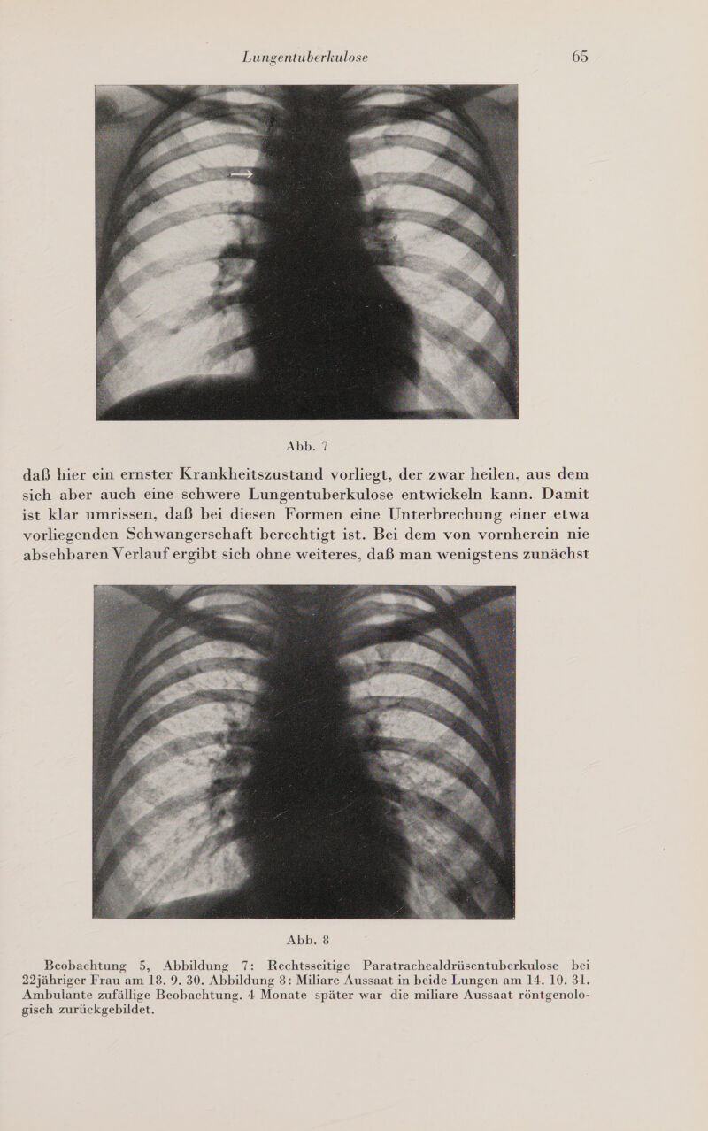  Abb. 7 daß hier ein ernster Krankheitszustand vorliegt, der zwar heilen, aus dem sich aber auch eine schwere Lungentuberkulose entwickeln kann. Damit ist klar umrissen, daß bei diesen Formen eine Unterbrechung einer etwa vorliegenden Schwangerschaft berechtigt ist. Bei dem von vornherein nie absehbaren Verlauf ergibt sich ohne weiteres, daß man wenigstens zunächst  Beobachtung 5, Abbildung 7: Rechtsseitige Paratrachealdrüsentuberkulose bei 22jähriger Frau am 18. 9. 30. Abbildung 8: Miliare Aussaat in beide Lungen am 14. 10. 31. Ambulante zufällige Beobachtung. 4 Monate später war die miliare Aussaat röntgenolo- gisch zurückgebildet.