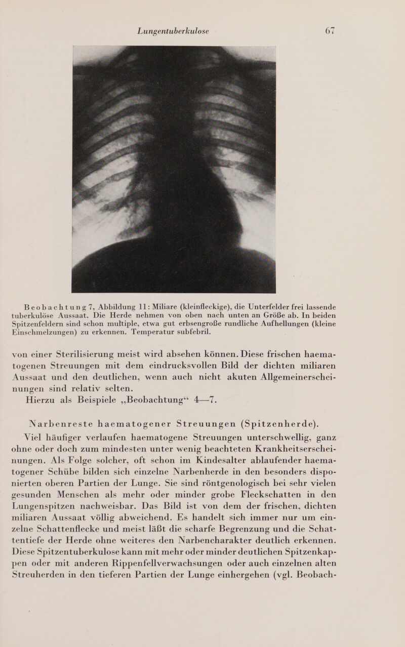  Beobachtung 7, Abbildung 11: Miliare (kleinfleckige), die Unterfelder frei lassende tuberkulöse Aussaat. Die Herde nehmen von oben nach unten an Größe ab. In beiden Spitzenfeldern sind schon multiple, etwa gut erbsengroße rundliche Aufhellungen (kleine Einschmelzungen) zu erkennen. Temperatur subfebril. von einer Sterilisierung meist wird absehen können. Diese frischen haema- togenen Streuungen mit dem eindrucksvollen Bild der dichten miliaren Aussaat und den deutlichen, wenn auch nicht akuten Allgemeinerschei- nungen sind relativ selten. Hierzu als Beispiele „Beobachtung“ 4—7. Narbenreste haematogener Streuungen (Spitzenherde). Viel häufiger verlaufen haematogene Streuungen unterschwellig, ganz ohne oder doch zum mindesten unter wenig beachteten Krankheitserschei- nungen. Als Folge solcher, oft schon im Kindesalter ablaufender haema- togener Schübe bilden sich einzelne Narbenherde in den besonders dispo- nierten oberen Partien der Lunge. Sie sind röntgenologisch bei sehr vielen gesunden Menschen als mehr oder minder grobe Fleckschatten in den Lungenspitzen nachweisbar. Das Bild ist von dem der frischen, dichten miliaren Aussaat völlig abweichend. Es handelt sich immer nur um ein- zelne Schattenflecke und meist läßt die scharfe Begrenzung und die Schat- tentiefe der Herde ohne weiteres den Narbencharakter deutlich erkennen. Diese Spitzentuberkulose kann mit mehr oder minder deutlichen Spitzenkap- pen oder mit anderen Rippenfellverwachsungen oder auch einzelnen alten Streuherden in den tieferen Partien der Lunge einhergehen (vgl. Beobach-