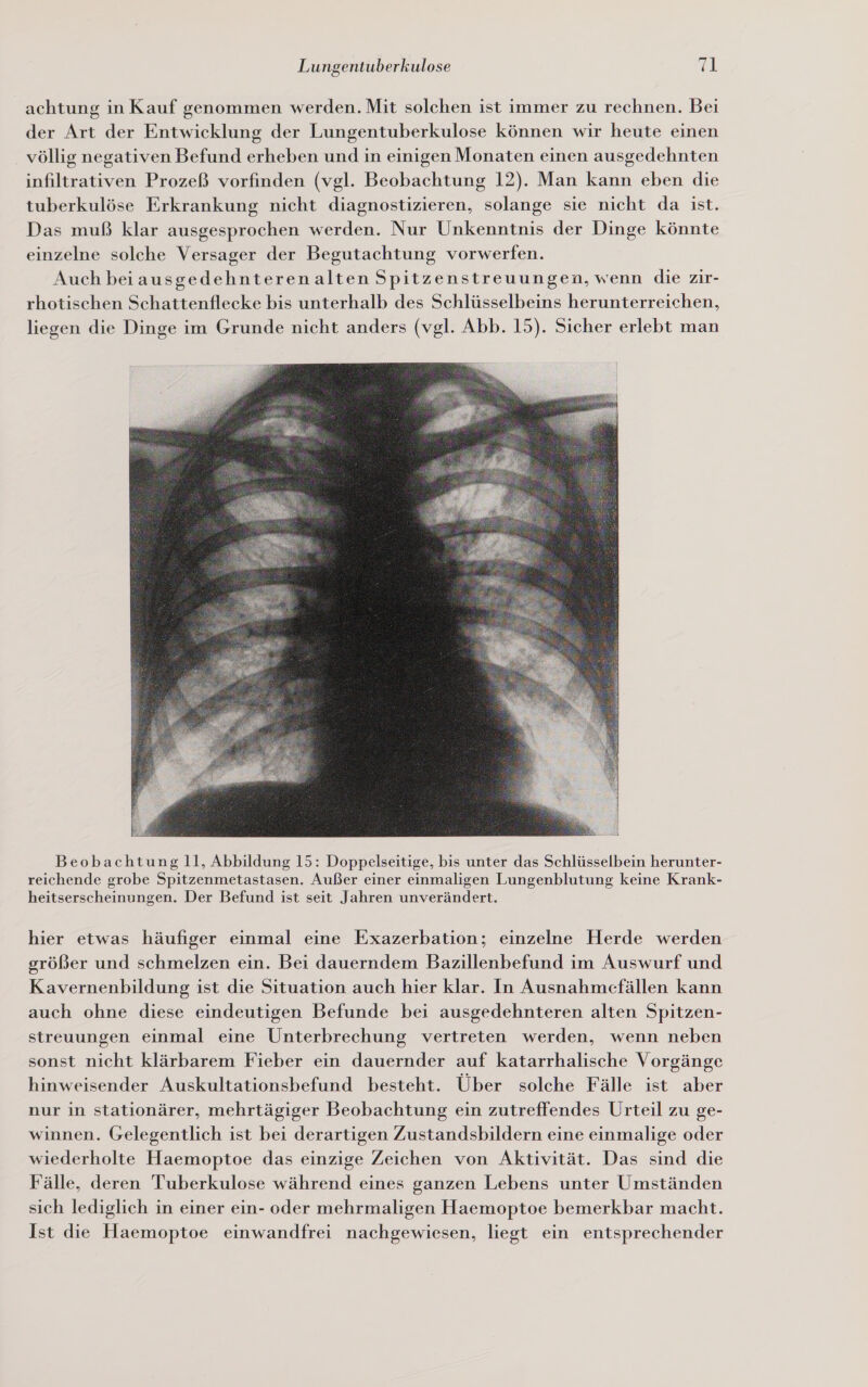 achtung in Kauf genommen werden. Mit solchen ist immer zu rechnen. Bei der Art der Entwicklung der Lungentuberkulose können wir heute einen völlig negativen Befund erheben und in einigen Monaten einen ausgedehnten infiltrativen Prozeß vorfinden (vgl. Beobachtung 12). Man kann eben die tuberkulöse Erkrankung nicht diagnostizieren, solange sie nicht da ist. Das muß klar ausgesprochen werden. Nur Unkenntnis der Dinge könnte einzelne solche Versager der Begutachtung vorwerfen. Auch beiausgedehnterenalten Spitzenstreuungen, wenn die zir- rhotischen Schattenflecke bis unterhalb des Schlüsselbeins herunterreichen, liegen die Dinge im Grunde nicht anders (vgl. Abb. 15). Sicher erlebt man 13%  Beobachtung ll, Abbildung 15: Doppelseitige, bis unter das Schlüsselbein herunter- reichende grobe Spitzenmetastasen. Außer einer einmaligen Lungenblutung keine Krank- heitserscheinungen. Der Befund ist seit Jahren unverändert. hier etwas häufiger einmal eine Exazerbation; einzelne Herde werden größer und schmelzen ein. Bei dauerndem Bazillenbefund im Auswurf und Kavernenbildung ist die Situation auch hier klar. In Ausnahmefällen kann auch ohne diese eindeutigen Befunde bei ausgedehnteren alten Spitzen- streuungen einmal eine Unterbrechung vertreten werden, wenn neben sonst nicht klärbarem Fieber ein dauernder auf katarrhalische Vorgänge hinweisender Auskultationsbefund besteht. Über solche Fälle ist aber nur in stationärer, mehrtägiger Beobachtung ein zutreffendes Urteil zu ge- winnen. Gelegentlich ist bei derartigen Zustandsbildern eine einmalige oder wiederholte Haemoptoe das einzige Zeichen von Aktivität. Das sind die Fälle, deren Tuberkulose während eines ganzen Lebens unter Umständen sich lediglich in einer ein- oder mehrmaligen Haemoptoe bemerkbar macht. Ist die Haemoptoe einwandfrei nachgewiesen, liegt ein entsprechender