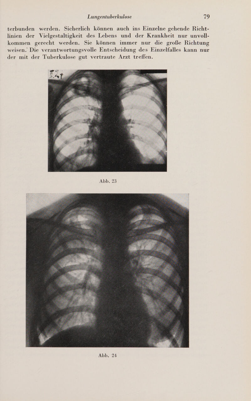 terbunden werden. Sicherlich können auch ins Einzelne gehende Richt- linien der Vielgestaltigkeit des Lebens und der Krankheit nur unvoll- kommen gerecht werden. Sie können immer nur die große Richtung weisen. Die verantwortungsvolle Entscheidung des Einzelfalles kann nur der mit der Tuberkulose gut vertraute Arzt treffen.  Abb, 23 