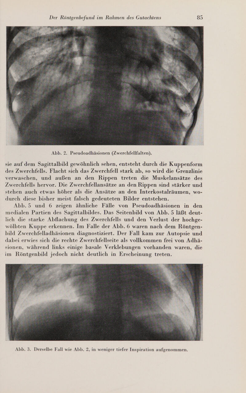  Abb. 2. Pseudoadhäsionen (Zwerchfellfalten). sie auf dem Sagittalbild gewöhnlich sehen, entsteht durch die Kuppenform des Zwerchfells. Flacht sich das Zwerchfell stark ab, so wird die Grenzlinie verwaschen, und außen an den Rippen treten die Muskelansätze des Zwerchfells hervor. Die Zwerchfellansätze an den Rippen sind stärker und stehen auch etwas höher als die Ansätze an den Interkostalräumen, wo- durch diese bisher meist falsch gedeuteten Bilder entstehen. Abb.5 und 6 zeigen ähnliche Fälle von Pseudoadhäsionen in den medialen Partien des Sagittalbildes. Das Seitenbild von Abb. 5 läßt deut- lich die starke Abflachung des Zwerchfells und den Verlust der hochge- wölbten Kuppe erkennen. Im Falle der Abb. 6 waren nach dem Röntgen- bild Zwerchfelladhäsionen diagnostiziert. Der Fall kam zur Autopsie und dabei erwies sich die rechte Zwerchfellseite als vollkommen frei von Adhä- sionen, während links einige basale Verklebungen vorhanden waren, die im Röntgenbild jedoch nicht deutlich in Erscheinung treten. 