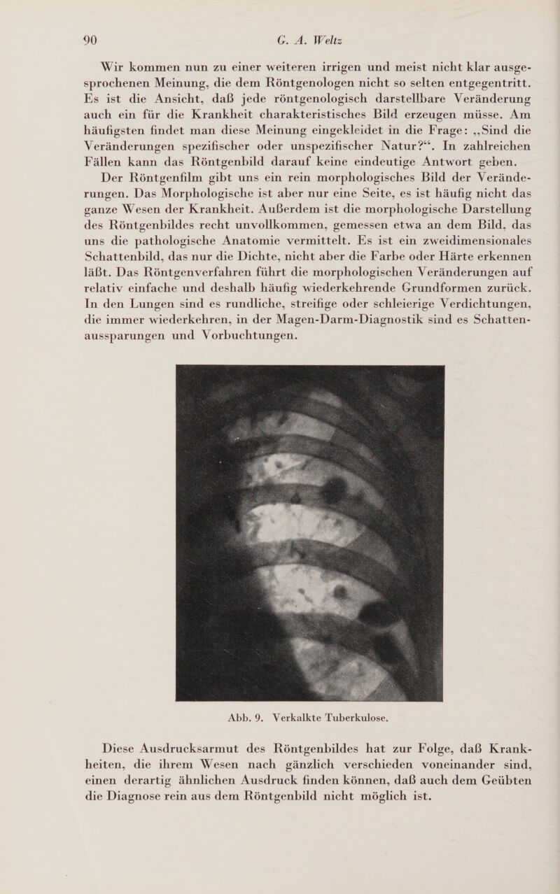 Wir kommen nun zu einer weiteren irrigen und meist nicht klar ausge- sprochenen Meinung, die dem Röntgenologen nicht so selten entgegentritt. Es ist die Ansicht, daß jede röntgenologisch darstellbare Veränderung auch ein für die Krankheit charakteristisches Bild erzeugen müsse. Am häufigsten findet man diese Meinung eingekleidet in die Frage: ‚Sind die Veränderungen spezifischer oder unspezifischer Natur?“. In zahlreichen Fällen kann das Röntgenbild darauf keine eindeutige Antwort geben. Der Röntgenfilm gibt uns ein rein morphologisches Bild der Verände- rungen. Das Morphologische ist aber nur eine Seite, es ist häufig nicht das ganze Wesen der Krankheit. Außerdem ist die morphologische Darstellung des Röntgenbildes recht unvollkommen, gemessen etwa an dem Bild, das uns die pathologische Anatomie vermittelt. Es ist ein zweidimensionales Schattenbild, das nur die Dichte, nicht aber die Farbe oder Härte erkennen läßt. Das Röntgenverfahren führt die morphologischen Veränderungen auf relativ einfache und deshalb häufig wiederkehrende Grundformen zurück. In den Lungen sind es rundliche, streifige oder schleierige Verdichtungen, die immer wiederkehren, in der Magen-Darm-Diagnostik sind es Schatten- aussparungen und Vorbuchtungen.  Diese Ausdrucksarmut des Röntgenbildes hat zur Folge, daß Krank- heiten, die ihrem Wesen nach gänzlich verschieden voneinander sind, einen derartig ähnlichen Ausdruck finden können, daß auch dem Geübten die Diagnose rein aus dem Röntgenbild nicht möglich ist.