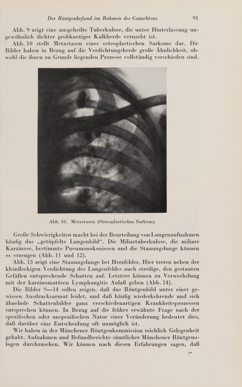 Abb. 9 zeigt eine ausgeheilte Tuberkulose, die unter Hinterlassung un- gewöhnlich dichter grobknotiger Kalkherde vernarbt ist. Abb. 10 stellt Metastasen eines osteoplastischen Sarkoms dar. Die Bilder haben in Bezug auf die Verdichtungsherde große Ähnlichkeit, ob- wohl die ihnen zu Grunde liegenden Prozesse vollständig verschieden sind.  Große Schwierigkeiten macht bei der Beurteilung von Lungenaufnahmen häufig das „‚getüpfelte Lungenbild“. Die Miliartuberkulose, die miliare Karzinose, bestimmte Pneumonokoniosen und die Stauungslunge können es erzeugen (Abb. 11 und 12). Abb. 13 zeigt eine Stauungslunge bei Herzfehler. Hier treten neben der kleinfleckigen Verdichtung des Lungenfeldes auch streifige, den gestauten Gefäßen entsprechende Schatten auf. Letztere können zu Verwechslung mit der karzinomatösen Lymphangitis Anlaß geben (Abb. 14). Die Bilder 9—14 sollen zeigen, daß das Röntgenbild unter einer ge- wissen Ausdrucksarmut leidet, und daß häufig wiederkehrende und sich ähnelnde Schattenbilder ganz verschiedenartigen Krankheitsprozessen entsprechen können. In Bezug auf die früher erwähnte Frage nach der spezifischen oder unspezifischen Natur einer Veränderung bedeutet dies, daß darüber eine Entscheidung oft unmöglich ist. Wir haben in der Münchener Röntgenkommission reichlich Gelegenheit gehabt, Aufnahmen und Befundberichte sämtlicher Münchener Röntgeno- logen durchzusehen. Wir können nach diesen Erfahrungen sagen, daß IE