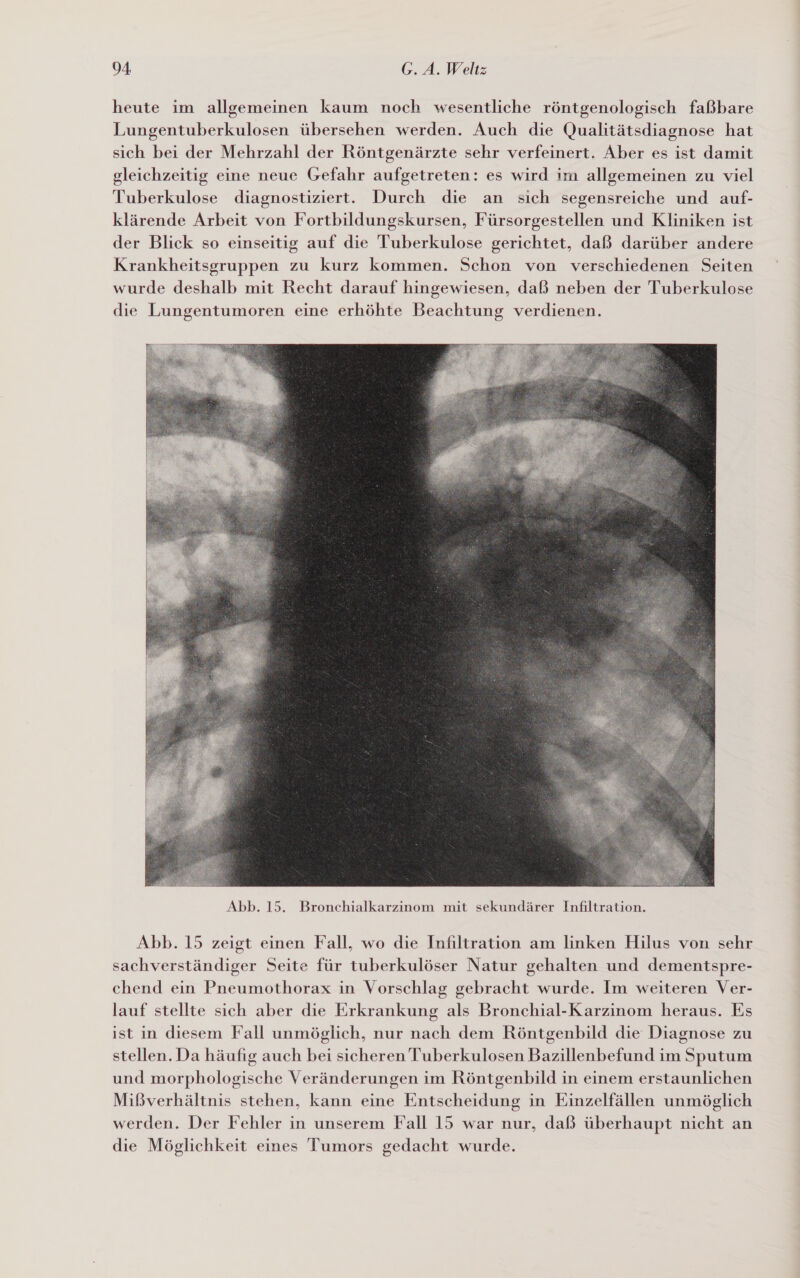 heute im allgemeinen kaum noch wesentliche röntgenologisch faßbare Lungentuberkulosen übersehen werden. Auch die Qualitätsdiagnose hat sich bei der Mehrzahl der Röntgenärzte sehr verfeinert. Aber es ist damit gleichzeitig eine neue Gefahr aufgetreten: es wird im allgemeinen zu viel Tuberkulose diagnostiziert. Durch die an sich segensreiche und auf- klärende Arbeit von Fortbildungskursen, Fürsorgestellen und Kliniken ist der Blick so einseitig auf die Tuberkulose gerichtet, daß darüber andere Krankheitsgruppen zu kurz kommen. Schon von verschiedenen Seiten wurde deshalb mit Recht darauf hingewiesen, daß neben der Tuberkulose die Lungentumoren eine erhöhte Beachtung verdienen.  Abb. 15 zeigt einen Fall, wo die Infiltration am linken Hilus von sehr sachverständiger Seite für tuberkulöser Natur gehalten und dementspre- chend ein Pneumothorax in Vorschlag gebracht wurde. Im weiteren Ver- lauf stellte sich aber die Erkrankung als Bronchial-Karzinom heraus. Es ist in diesem Fall unmöglich, nur nach dem Röntgenbild die Diagnose zu stellen. Da häufig auch bei sicheren Tuberkulosen Bazillenbefund im Sputum und morphologische Veränderungen im Röntgenbild in einem erstaunlichen Mißverhältnis stehen, kann eine Entscheidung in Einzelfällen unmöglich werden. Der Fehler in unserem Fall 15 war nur, daß überhaupt nicht an die Möglichkeit eines Tumors gedacht wurde.