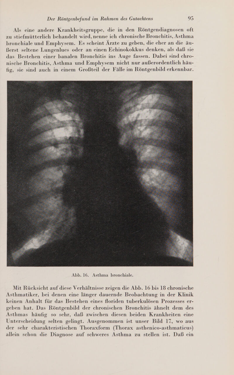 Als eine andere Krankheitsgruppe, die in den Röntgendiagnosen oft zu stiefmütterlich behandelt wird, nenne ich chronische Bronchitis, Asthma bronchiale und Emphysem. Es scheint Ärzte zu geben, die eher an die äu- Berst seltene Lungenlues oder an einen Echinokokkus denken, als daß sie das Bestehen einer banalen Bronchitis ins Auge fassen. Dabei sind chro- nische Bronchitis, Asthma und Emphysem nicht nur außerordentlich häu- fig, sie sind auch in einem Großteil der Fälle im Röntgenbild erkennbar.  Mit Rücksicht auf diese Verhältnisse zeigen die Abb. 16 bis 18 chronische Asthmatiker, bei denen eine länger dauernde Beobachtung in der Klinik keinen Anhalt für das Bestehen eines floriden tuberkulösen Prozesses er- geben hat. Das Röntgenbild der chronischen Bronchitis ähnelt dem des Asthmas häufig so sehr, daß zwischen diesen beiden Krankheiten eine Unterscheidung selten gelingt. Ausgenommen ist unser Bild 17, wo aus der sehr charakteristischen Thoraxform (Thorax asthenico-asthmaticus) allein schon die Diagnose auf schweres Asthma zu stellen ist. Daß ein