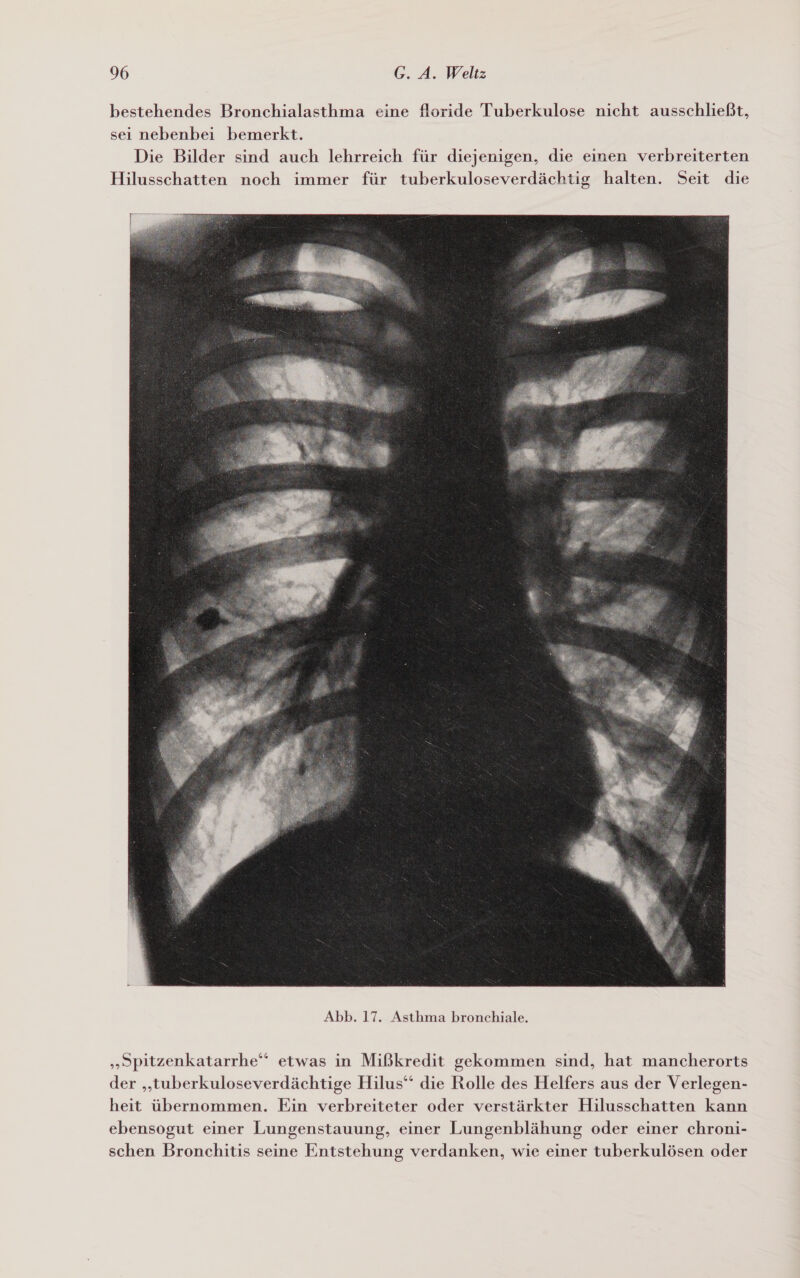 bestehendes Bronchialasthma eine floride Tuberkulose nicht ausschließt, sei nebenbei bemerkt. Die Bilder sind auch lehrreich für diejenigen, die einen verbreiterten Hilusschatten noch immer für tuberkuloseverdächtig halten. Seit die  „Spitzenkatarrhe‘ etwas in Mißkredit gekommen sind, hat mancherorts der „tuberkuloseverdächtige Hilus“ die Rolle des Helfers aus der Verlegen- heit übernommen. Ein verbreiteter oder verstärkter Hilusschatten kann ebensogut einer Lungenstauung, einer Lungenblähung oder einer chroni- schen Bronchitis seine Entstehung verdanken, wie einer tuberkulösen oder