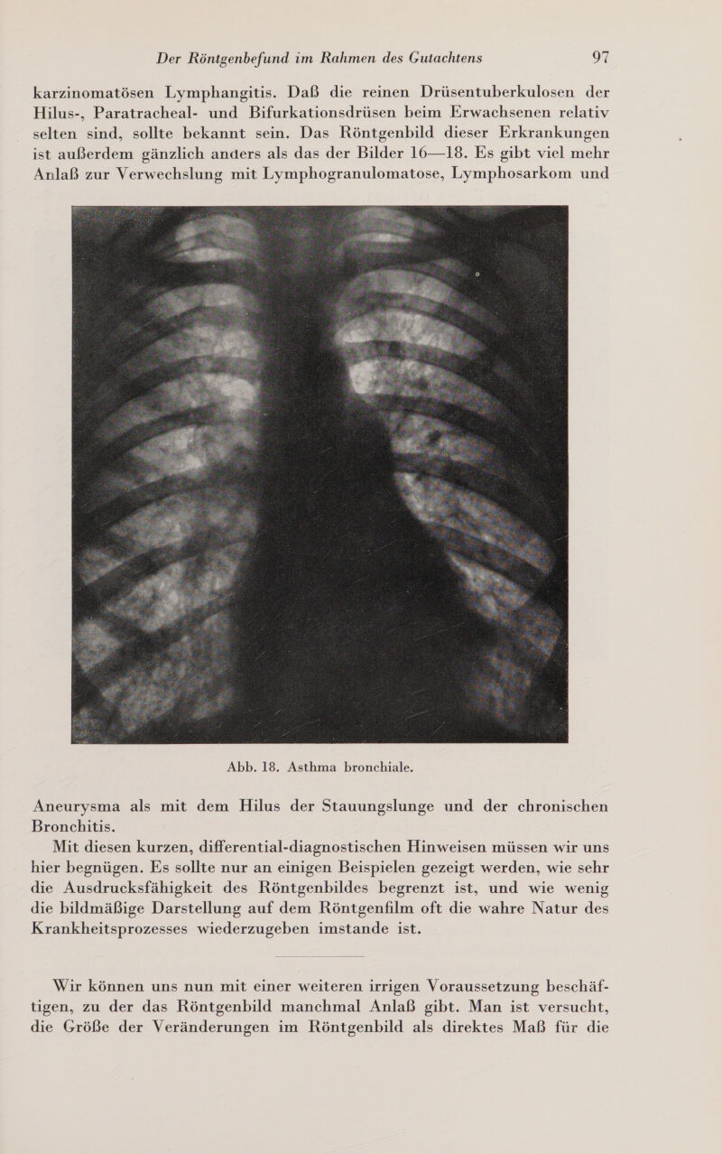 karzinomatösen Lymphangitis. Daß die reinen Drüsentuberkulosen der Hilus-, Paratracheal- und Bifurkationsdrüsen beim Erwachsenen relativ selten sind, sollte bekannt sein. Das Röntgenbild dieser Erkrankungen ist außerdem gänzlich anders als das der Bilder 16—18. Es gibt viel mehr Anlaß zur Verwechslung mit Lymphogranulomatose, Lymphosarkom und  Aneurysma als mit dem Hilus der Stauungslunge und der chronischen Bronchitis. Mit diesen kurzen, differential-diagnostischen Hinweisen müssen wir uns hier begnügen. Es sollte nur an einigen Beispielen gezeigt werden, wie sehr die Ausdrucksfähigkeit des Röntgenbildes begrenzt ist, und wie wenig die bildmäßige Darstellung auf dem Röntgenfilm oft die wahre Natur des Krankheitsprozesses wiederzugeben imstande ist.  Wir können uns nun mit einer weiteren irrigen Voraussetzung beschäf- tigen, zu der das Röntgenbild manchmal Anlaß gibt. Man ist versucht, die Größe der Veränderungen im Röntgenbild als direktes Maß für die