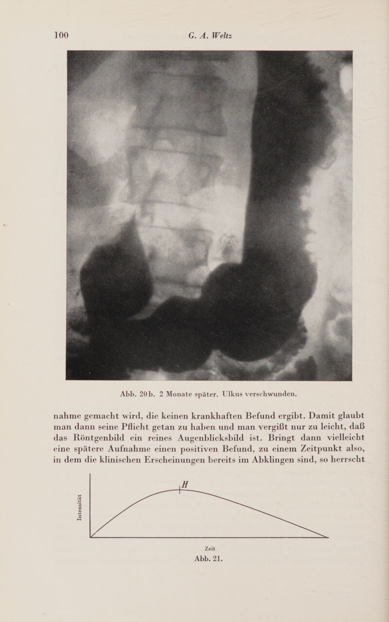  nahme gemacht wird, die keinen krankhaften Befund ergibt. Damit glaubt man dann seine Pflicht getan zu haben und man vergißt nur zu leicht, daß das Röntgenbild ein reines Augenblicksbild ist. Bringt dann vielleicht eine spätere Aufnahme einen positiven Befund, zu einem Zeitpunkt also, in dem die klinischen Erscheinungen bereits im Abklingen sind, so herrscht H Intensität Zeit Abb. 21.