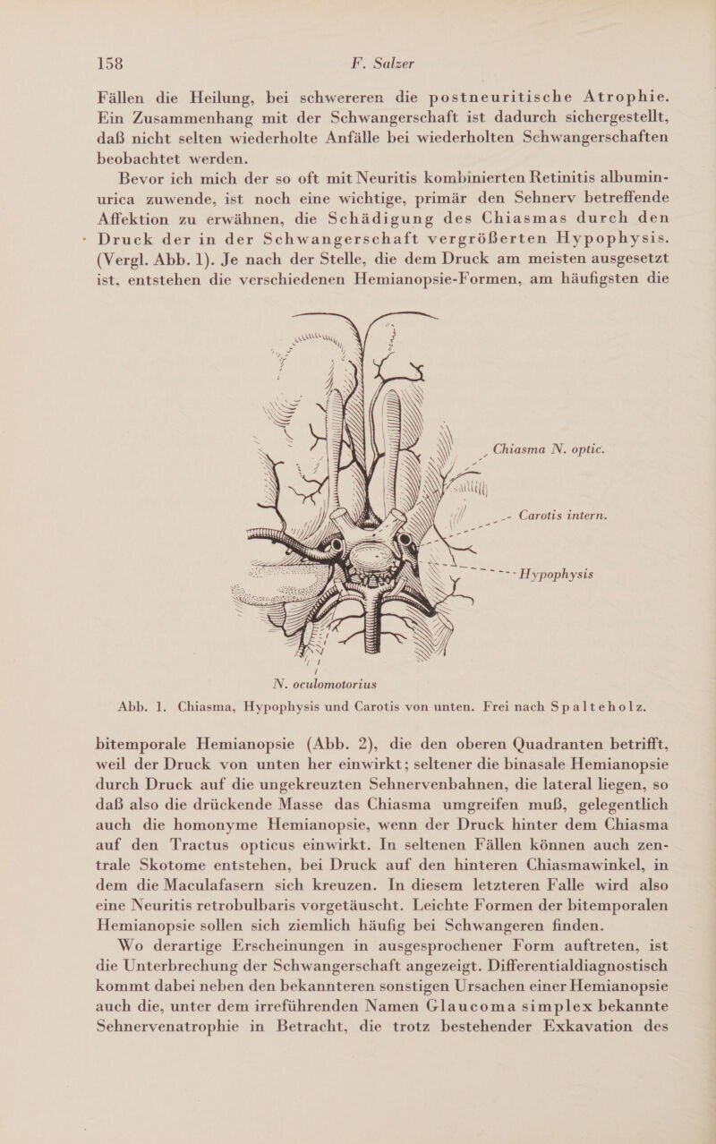 Fällen die Heilung, bei schwereren die postneuritische Atrophie. Ein Zusammenhang mit der Schwangerschaft ist dadurch sichergestellt, daß nicht selten wiederholte Anfälle bei wiederholten Schwangerschaften beobachtet werden. Bevor ich mich der so oft mit Neuritis kombinierten Retinitis albumin- urica zuwende, ist noch eine wichtige, primär den Sehnerv betreffende Affektion zu erwähnen, die Schädigung des Chiasmas durch den Druck der in der Schwangerschaft vergrößerten Hypophysis. (Vergl. Abb. 1). Je nach der Stelle, die dem Druck am meisten ausgesetzt ist, entstehen die verschiedenen Hemianopsie-Formen, am häufigsten die Sal’ _ -- Carotis intern. _— ._ m Hypophysis  Abb. 1. Chiasma, Hypophysis und Carotis von unten. Frei nach Spalteholz. bitemporale Hemianopsie (Abb. 2), die den oberen Quadranten betrifft, weil der Druck von unten her einwirkt; seltener die binasale Hemianopsie durch Druck auf die ungekreuzten Sehnervenbahnen, die lateral liegen, so daß also die drückende Masse das Chiasma umgreifen muß, gelegentlich auch die homonyme Hemianopsie, wenn der Druck hinter dem Chiasma auf den Tractus opticus einwirkt. In seltenen Fällen können auch zen- trale Skotome entstehen, bei Druck auf den hinteren Chiasmawinkel, in dem die Maculafasern sich kreuzen. In diesem letzteren Falle wird also eine Neuritis retrobulbaris vorgetäuscht. Leichte Formen der bitemporalen Hemianopsie sollen sich ziemlich häufig bei Schwangeren finden. Wo derartige Erscheinungen in ausgesprochener Form auftreten, ist die Unterbrechung der Schwangerschaft angezeigt. Differentialdiagnostisch kommt dabei neben den bekannteren sonstigen Ursachen einer Hemianopsie auch die, unter dem irreführenden Namen Glaucoma simplex bekannte Sehnervenatrophie in Betracht, die trotz bestehender Exkavation des