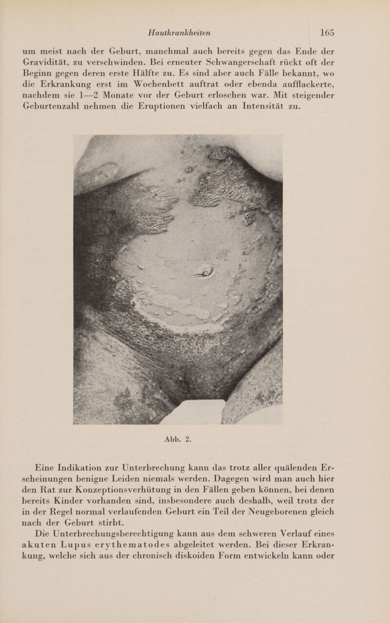 um meist nach der Geburt, manchmal auch bereits gegen das Ende der Gravidität, zu verschwinden. Bei erneuter Schwangerschaft rückt oft der Beginn gegen deren erste Hälfte zu. Es sind aber auch Fälle bekannt, wo die Erkrankung erst im Wochenbett auftrat oder ebenda aufflackerte, nachdem sie 1—2 Monate vor der Geburt erloschen war. Mit steigender Geburtenzahl nehmen die Eruptionen vielfach an Intensität zu.  Eine Indikation zur Unterbrechung kann das trotz aller quälenden Er- scheinungen benigne Leiden niemals werden. Dagegen wird man auch hier den Rat zur Konzeptionsverhütung in den Fällen geben können, bei denen bereits Kinder vorhanden sind, insbesondere auch deshalh, weil trotz der in der Regel normal verlaufenden Geburt ein Teil der Neugeborenen gleich nach der Geburt stirbt. Die Unterbrechungsberechtigung kann aus dem schweren Verlauf eines akuten Lupus erythematodes abgeleitet werden. Bei dieser Erkran- kung, welche sich aus der chronisch diskoiden Form entwickeln kann oder