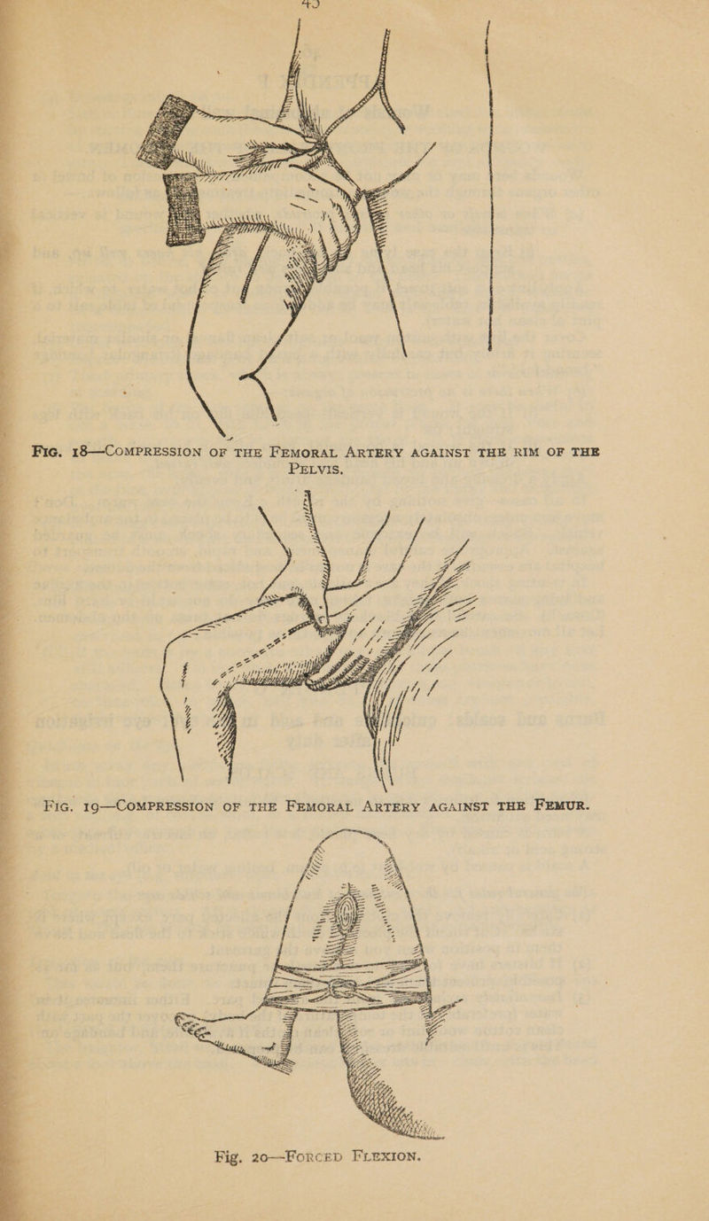  a Fic. 18—CoMPRESSION OF THE FEMORAL ARTERY AGAINST THE RIM OF THE PELVIS. ates Thee, 