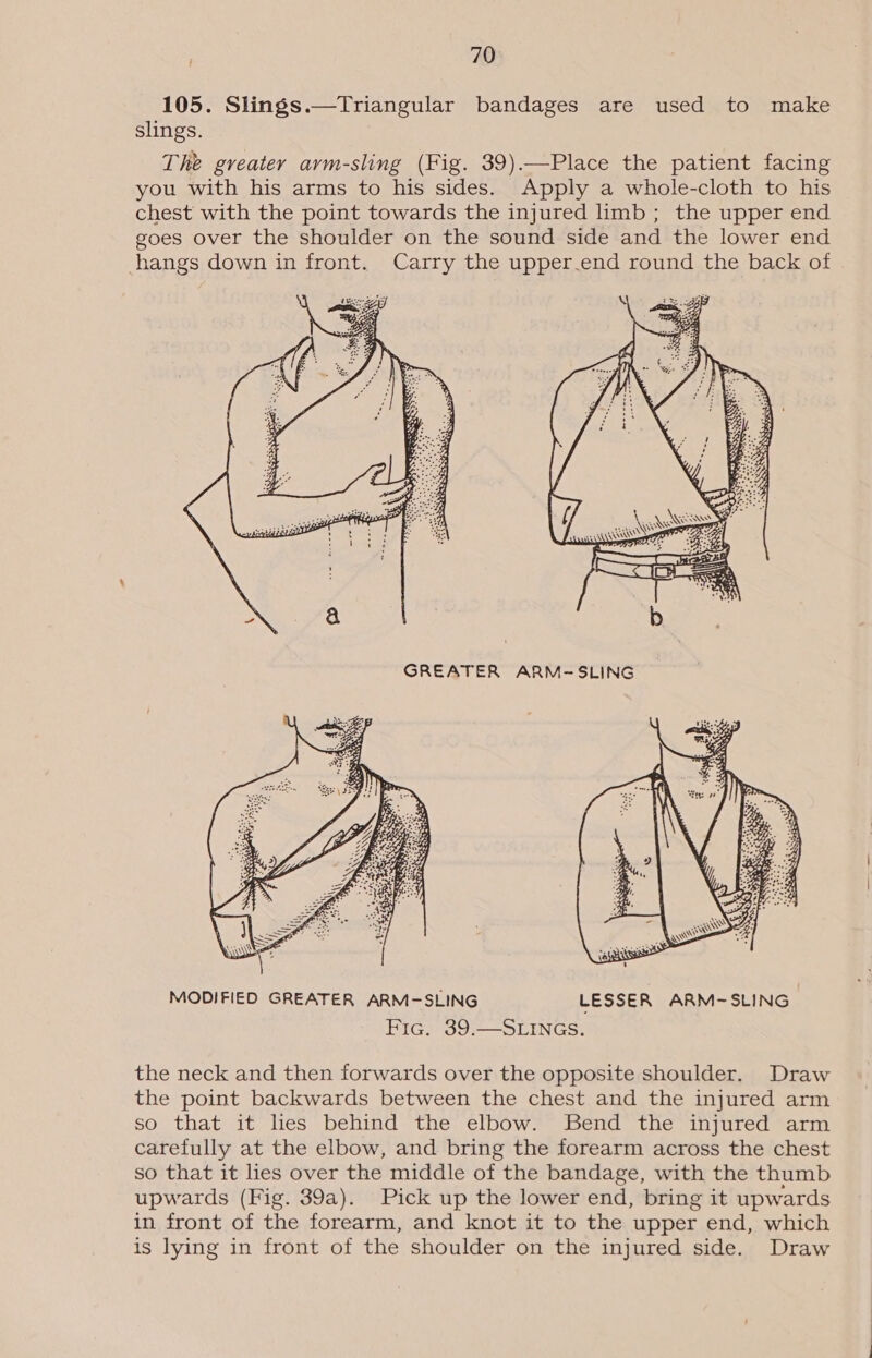 105. Slings.—Triangular bandages are used to make slings. The greater arm-sling (Fig. 39).—Place the patient facing you with his arms to his sides. Apply a whole-cloth to his chest with the point towards the injured limb; the upper end goes over the shoulder on the sound side and the lower end hangs down in front. Carry the upper.end round the back of  GREATER ARM-SLING  MODIFIED GREATER ARM-SLING LESSER ARM-SLING Fic. 39.—SLINGS. the neck and then forwards over the opposite shoulder. Draw the point backwards between the chest and the injured arm so that it lies behind the elbow. Bend the injured arm carefully at the elbow, and bring the forearm across the chest so that it lies over the middle of the bandage, with the thumb upwards (Fig. 39a). Pick up the lower end, bring it upwards in front of the forearm, and knot it to the upper end, which is lying in front of the shoulder on the injured side. Draw