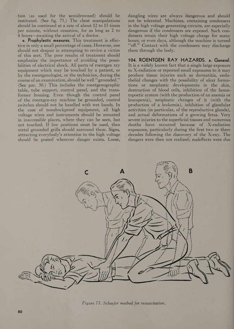 tion (as used for the semidrowned) should be instituted. (See fig. 73.) The chest manipulations should be continued at a rate of about 12 to 15 times per minute, without cessation, for as long as 2 to 4 hours—awaiting the arrival of a doctor. e. Prophylactic measures. This treatment is effec- tive in only a small percentage of cases. However, one should not despair in attempting to revive a victim of this sort. The poor results of treatment should emphasize the importance of avoiding the possi- bilities of electrical shock. All parts of roentgen ray equipment which may be touched by a patient, or by the roentgenologist, or the technician, during the course of an examination, should be well “grounded.” (See par. 30.) This includes the roentgenographic table, tube support, control panel, and the trans- former housing. Even though the control panel of the roentgen-ray machine be grounded, control switches should not be handled with wet hands. In the case of nonshockproof equipment, all high voltage wires and instruments should be mounted in inaccessible places, where they can be seen, but not touched. If Jow positions must be used, then metal grounded grills should surround them. Signs, attracting everybody’s attention to the high voltage should be posted wherever danger exists. Loose,  dangling wires are always dangerous and should not be tolerated. Machines, containing condensers in the high voltage generating circuits, are especially dangerous if the condensers are exposed. Such con- densers retain their high voltage charge for many hours, or even days, although the machine Is turned “off.” Contact with the condensers may discharge them through the body. 104. ROENTGEN RAY HAZARDS. a. General. It is a widely known fact that a single large exposure to X-radiation or repeated small exposures to it may produce tissue injuries such as dermatitis, endo- thelial changes with the possibility of ulcer forma- tions or neoplastic developments in the skin, destruction of blood cells, inhibition of the hema- topoetic system (with the production of an anemia or leucopenia), neoplastic changes of it (with the production of a leukemia), mhibition of glandular activities (in particular, of the reproductive glands), and actual deformations of a growing fetus. Very severe injuries to the superficial tissues and numerous deaths have occurred because of X-radiation exposures, particularly during the first two or three decades following the discovery of the X-ray. The dangers were then not realized; maleffects were due = acu J ee oe oa arson ’