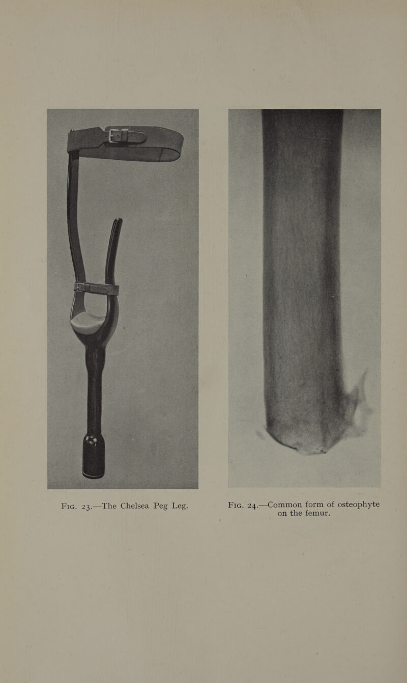  Fic. 23.—The Chelsea Peg Leg. Fic. 24.—Common form of osteophyte on the femur,