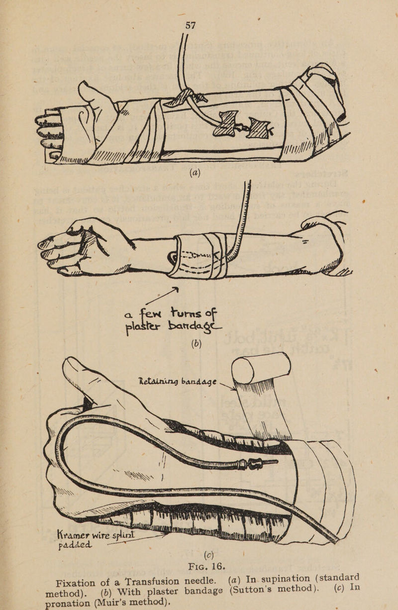  Fic. 16. Fixation of a Transfusion needle. ( method). (b) With plaster bandage (Sutton's method). pronation (Muir’s method), a) In supination ( standard (c) In