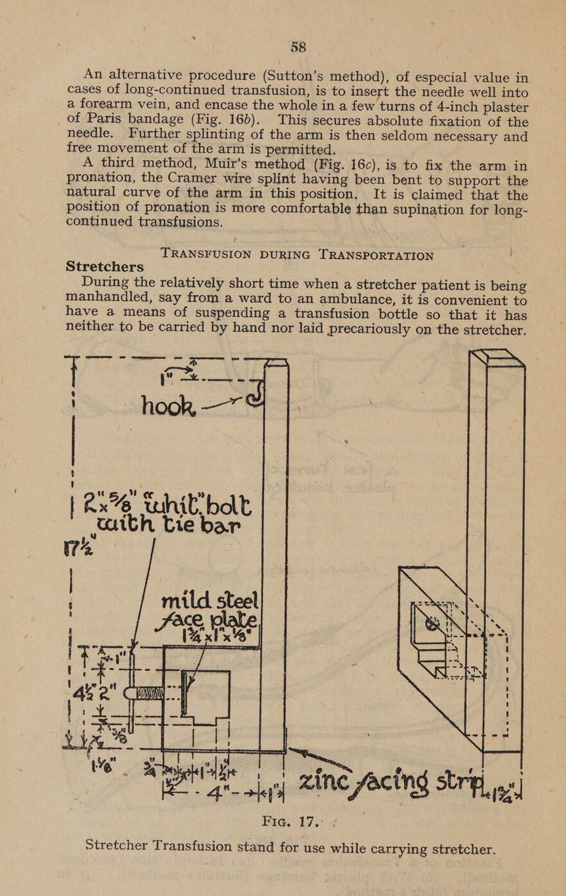 » 58 An alternative procedure (Sutton’s method), of especial value in cases of long-continued transfusion, is to insert the needle well into a forearm vein, and encase the whole in a few turns of 4-inch plaster of Paris bandage (Fig. 16d). This secures absolute fixation of the needle. Further splinting of the arm is then seldom necessary and free movement of the arm is permitted. A third method, Muir’s method (Fig. 16c), is to fix the arm in pronation, the Cramer wire splint having been bent to support the natural curve of the arm in this position, It is claimed that the position of pronation is more comfortable than supination for long- continued transfusions. } TRANSFUSION DURING TRANSPORTATION Stretchers During the relatively short time when a stretcher patient is being | manhandled, say from a ward to an ambulance, it is convenient to have a means of suspending a transfusion bottle so that it has neither to be carried by hand nor laid precariously on the stretcher. T] Ww ¢¢ hh Rx% whil bolt ; | maith Cie bar 17% |    “ i rly L Dra 8, coat ’ Se iggy Zinc facing striq, 0) Bag. 17: us Stretcher Transfusion stand for use while carrying stretcher.