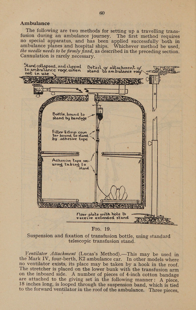 Ambulance The following are two methods for setting up a travelling trans- fusion during an ambulance journey. The first method requires no special apparatus, and has been applied successfully both in ambulance planes and hospital ships. Whichever method be used, the needle needs to be firmly fixed, as described in the preceding section. Cannulation is rarely necessary.  Stand collapsed, and clipped : : PP Detarl_o¢ abbachment te prpesmlance roy, ahen stand te ambulance we —: : SES Rs = Wiptay.aelts Wh ae are rae LOPE IN pS Seen bOI) Lf) Bottle bound to _~ he stand by bandage ty OE = es ee 3 ba EAE: Can a ES See Se Ses be 7 it ee A Or es Adhesive tape sec~ uring tubing to ants stand bat: Hee OF Eee fo =GAas ksi ce Pri pe re 0.75 ieR ~S Cet  Floor-plate aith hole to yeceive extended stand  Fie. 19. Suspension and fixation of transfusion bottle, using standard telescopic transfusion stand. Ventilator Attachment (Lucas’s Method).—This may be used in the Mark IV, four-berth, K2 ambulance car. In other models where no ventilator exists, its place may be taken by a hook in the roof. The stretcher is placed on the lower bunk with the transfusion arm on the inboard side. A number of pieces of 4-inch cotton bandage are attached to the giving set in the following manner: A piece, 18 inches long, is looped through the suspension band, which is tied to the forward ventilator in the roof of the ambulance. Three pieces,