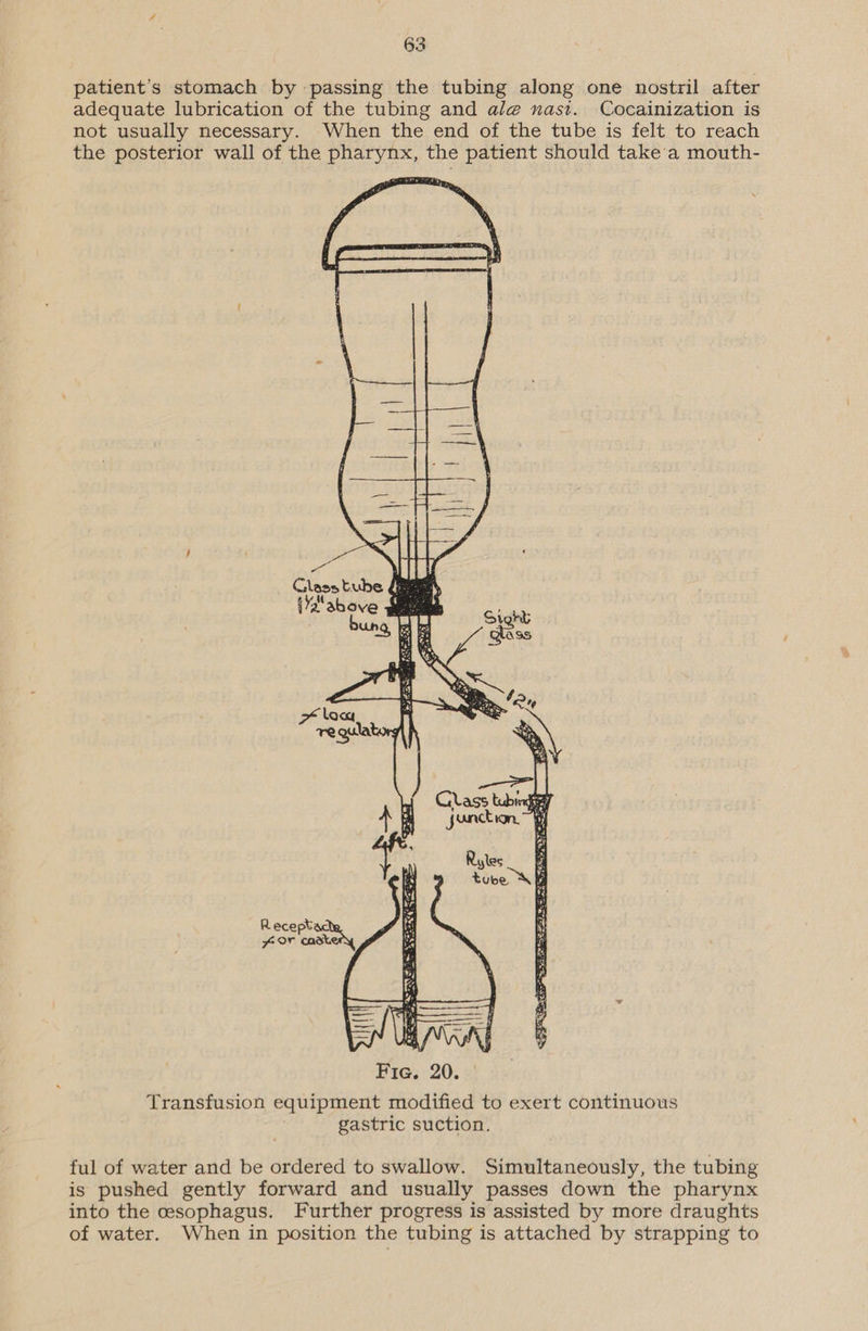 patient's stomach by passing the tubing along one nostril after adequate lubrication of the tubing and alge nast. Cocainization is not usually necessary. When the end of the tube is felt to reach the posterior wall of the pharynx, the patient should take a mouth-  Recept cent Transfusion equipment modified to exert continuous gastric suction. ful of water and be ordered to swallow. Simultaneously, the tubing is pushed gently forward and usually passes down the pharynx into the cesophagus. Further progress is assisted by more draughts of water. When in position the tubing is attached by strapping to