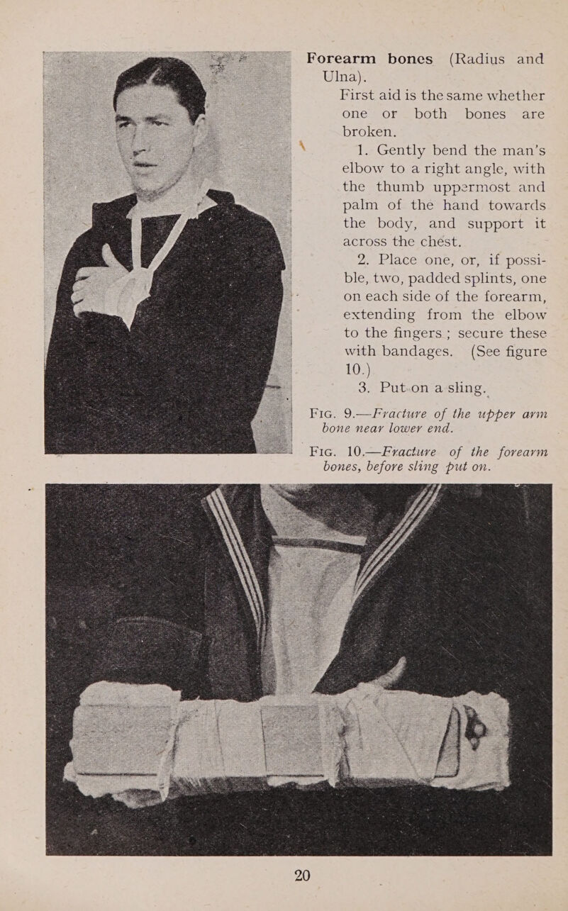 Forearm bones (Radius and UlIna). First aid is the same whether one or both bones are broken. 1. Gently bend the man’s elbow to a right angle, with the thumb uppermost and palm of the hand towards the body, and support it across the chest. 2. Place one, or, if possi- ble, two, padded splints, one on each side of the forearm, extending from the elbow to the fingers ; secure these with bandages. (See figure 10.) 3. Put-on ashing.  Fic. 9.—Fracture of the upper arm bone near lower end.  Fic. 10.—Fractuve of the forearm bones, before sling put on. 