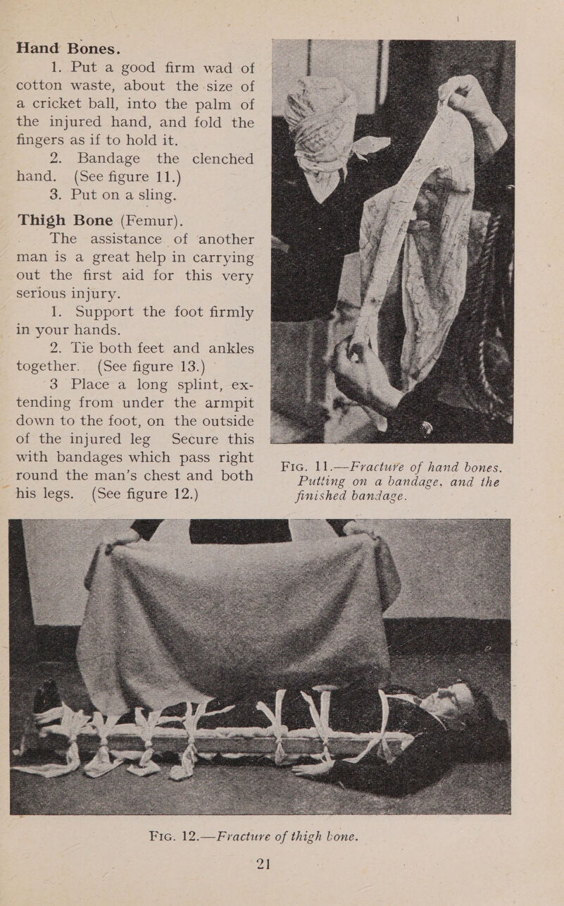Hand Bones. 1. Put a good firm wad of cotton waste, about the-size of a cricket ball, into the palm of the injured hand, and fold the fingers as if to hold it. 2. Bandage . the clenched hand. (See figure 11.) 3. Put on a sling. Thigh Bone (Femur). The assistance of another man is a great help in carrying out the first aid for this very serious injury. f support the foot firmly in your hands. 2. Tie both feet and ankles together’ (See figure 113.) 3 Place a long splint, ex- tending from under the armpit down to the foot, on the outside Oi, the mmyjured: leg. ‘Sécure this Ee eee nie, pass light Fic. 11.—Fracture of hand bones. round the man’s chest and both Putting on a bandage, and the ~ his legs. (See figure 12.) finished bandage.   2]
