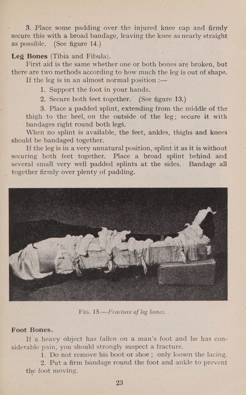 3. Place some padding over the injured knee cap and firmly secure this with a broad bandage, leaving the knee as nearly straight as possible. (See figure 14.) Leg Bones (Tibia and Fibula). First aid is the same whether one or both bones are broken, but there are two methods according to how much the leg is out of shape. If the leg is in an almost normal position :— 1. Support the foot in your hands. 2. Secure both feet together. (See figure 13.) 3. Place a padded splint, extending from the middle of the thigh to the heel, on the outside of the leg; secure it with bandages right round both legs. When no splint is available, the feet, ankles, thighs and knees should be bandaged together. ; If the leg is in a very unnatural position, splint it as it is without securing both feet together. Place a broad splint behind and several small very well padded splints at the sides.. Bandage all together firmly over plenty of padding.   Fracture of leg bones. Foot Bones. If a heavy object has fallen on a man’s foot and he has con- siderable pain, you should strongly suspect a fracture. 1. Do not remove his boot or shoe ; only loosen the lacing. 2. Put a firm bandage round the foot and ankle to prevent the foot moving.